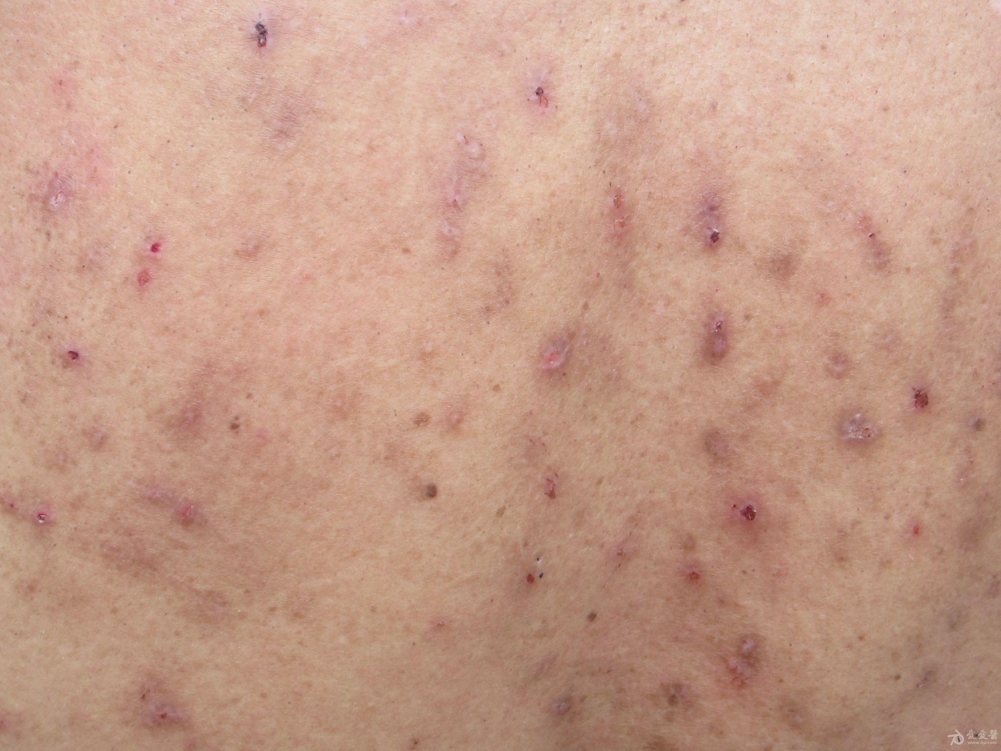 红斑丘疹的症状图片图片