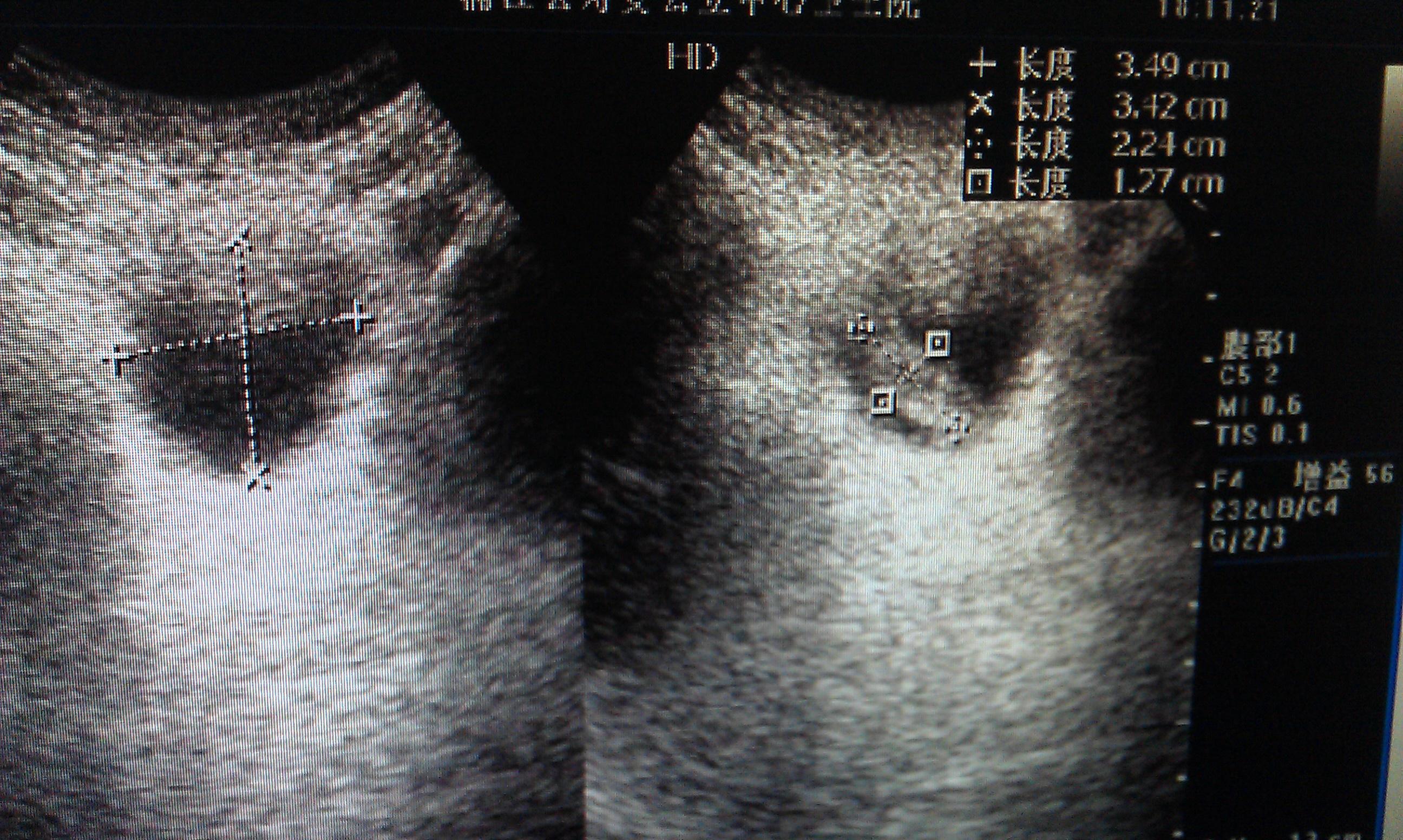 请各位老师看看这个是畸胎瘤吗