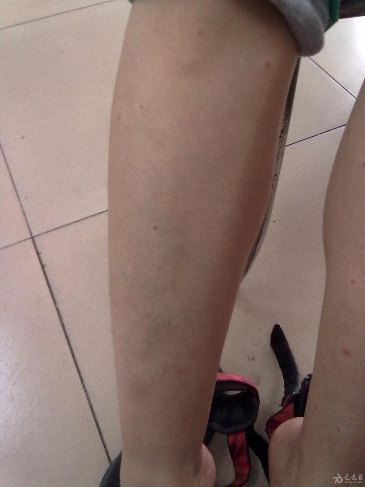 过敏性紫癜一例