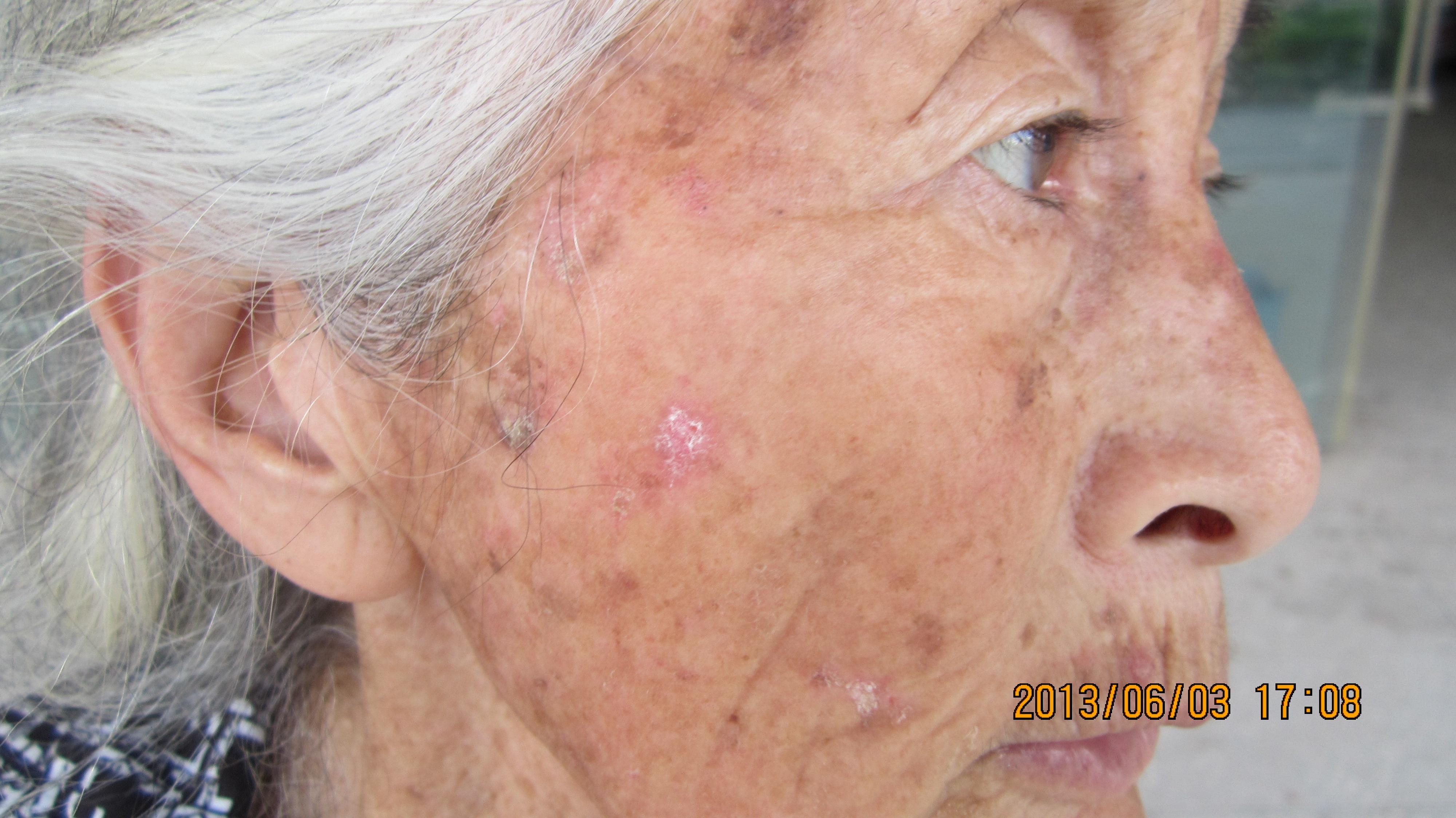 老年女性患者脸部皮损