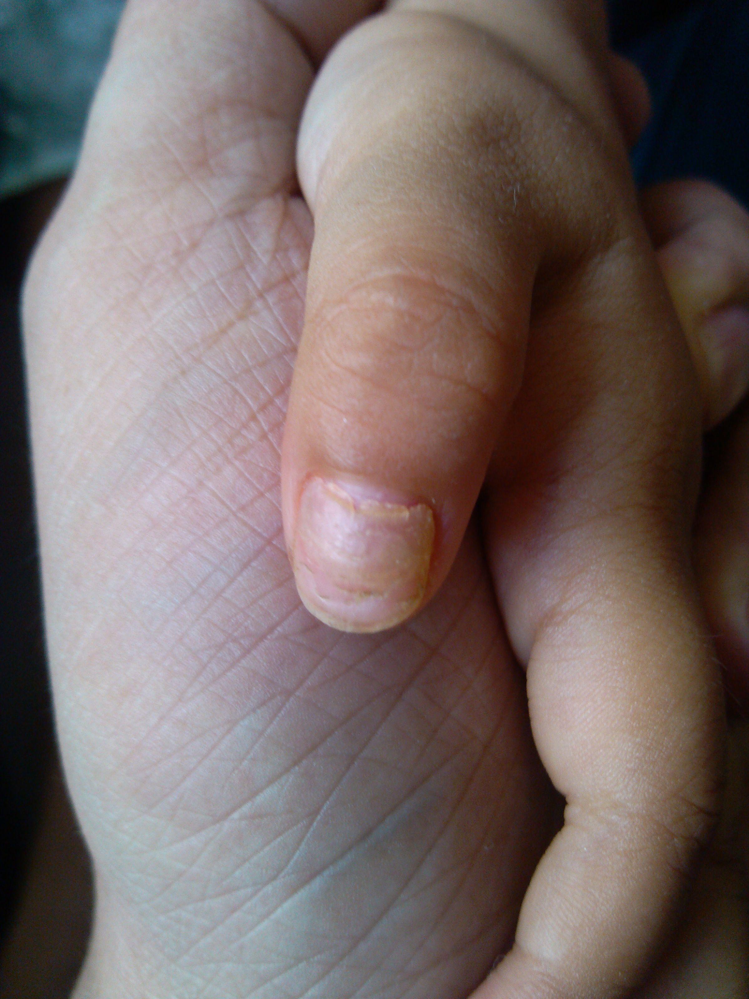 请专家会诊儿童指甲变形