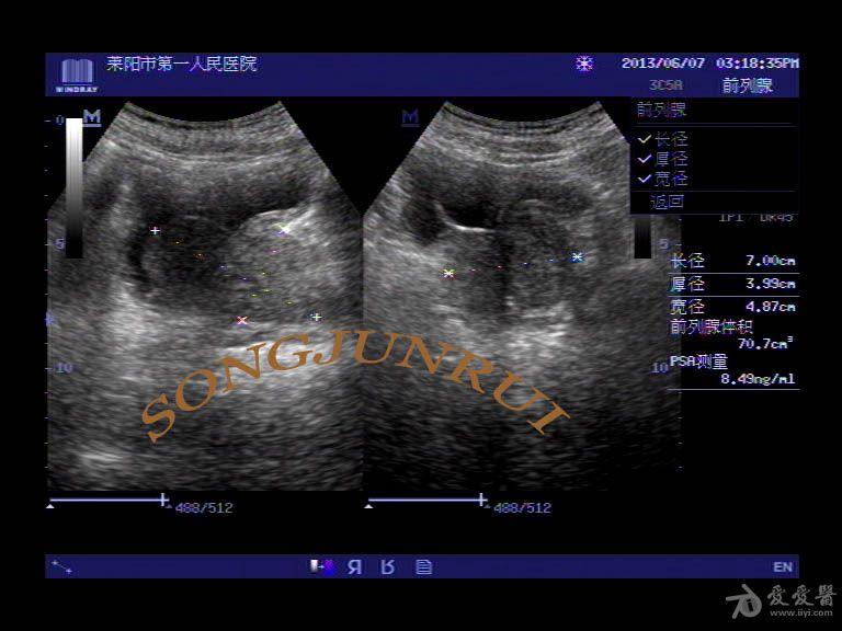 超声入门贴99前列腺增生