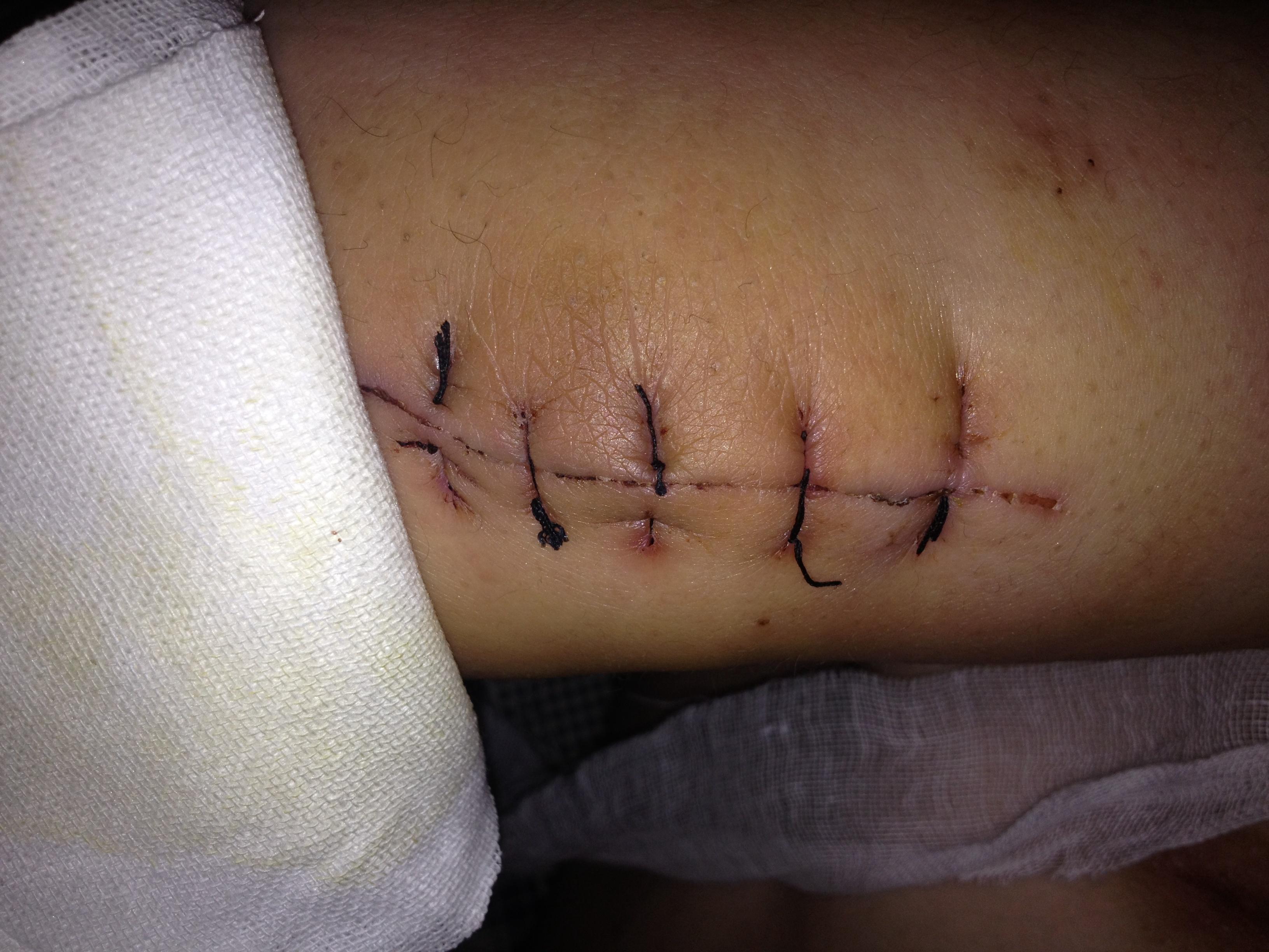 微创手术伤口恢复图图片