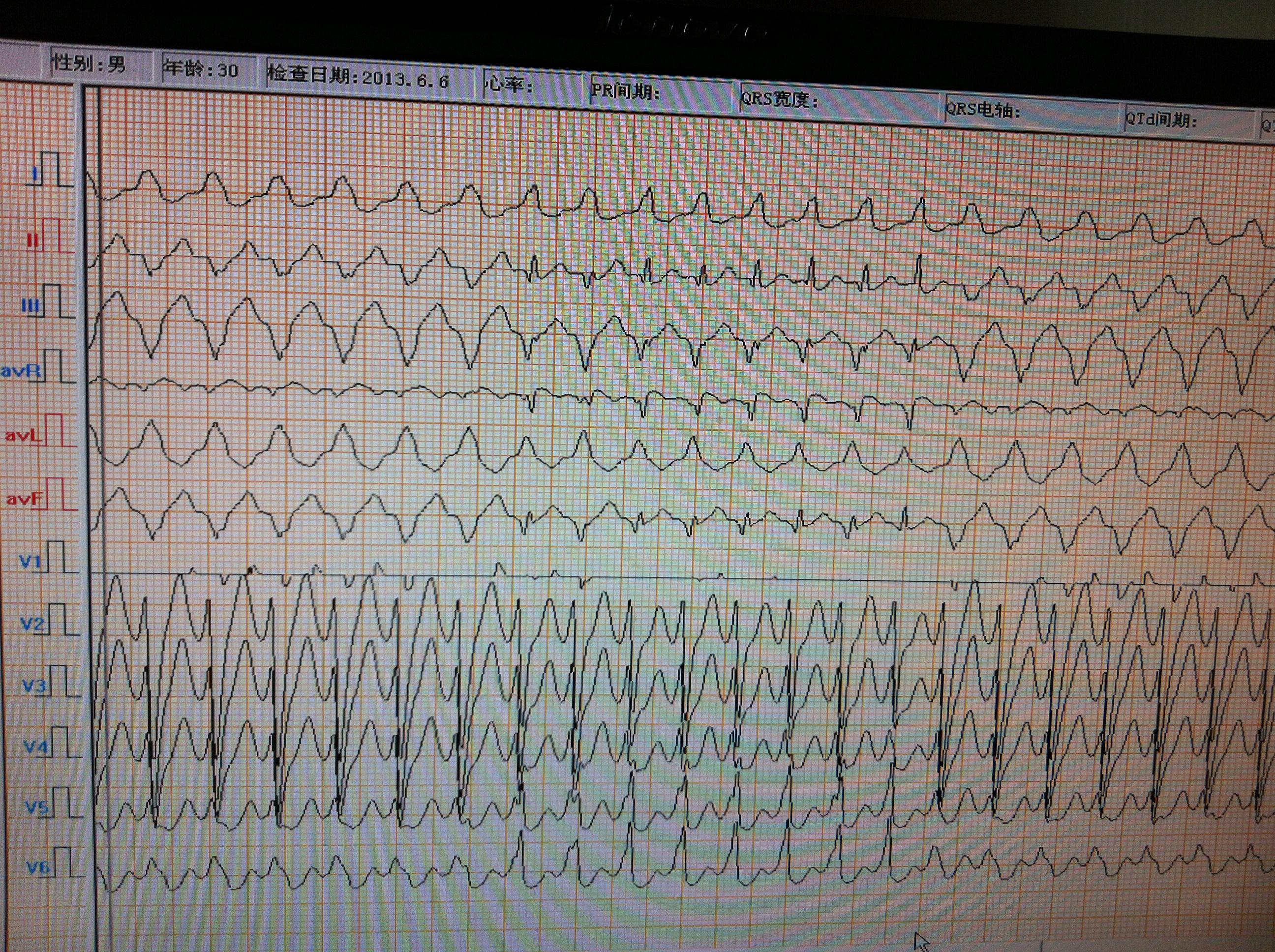 室速心电图图形图片