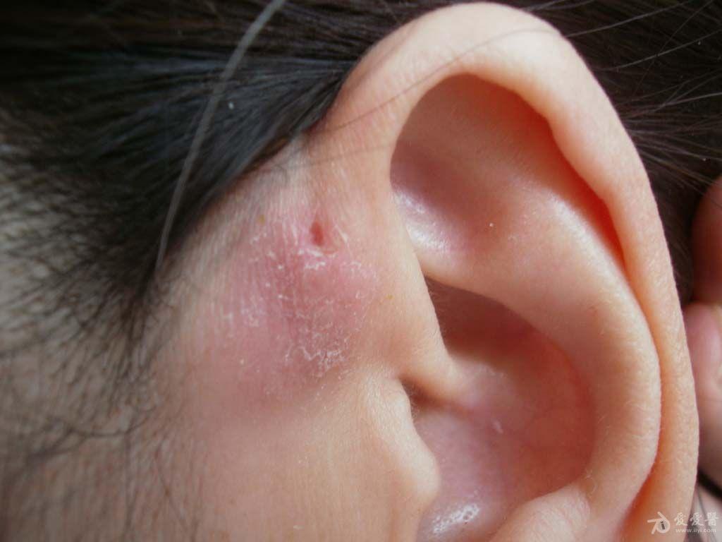 耳前瘘管发炎化脓图片
