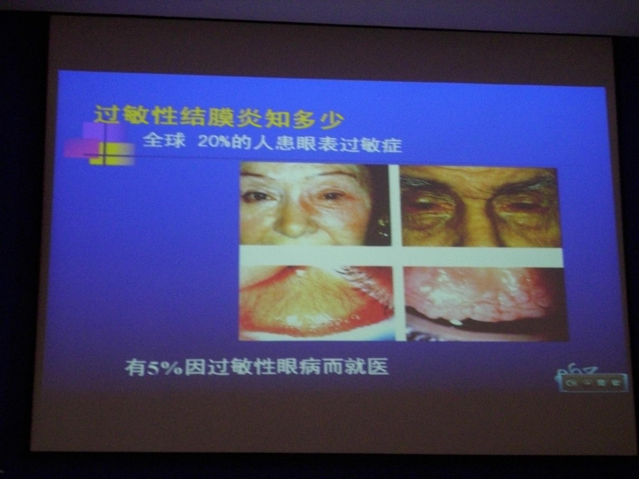 2013年愛愛醫眼科學術會內容過敏性結膜炎