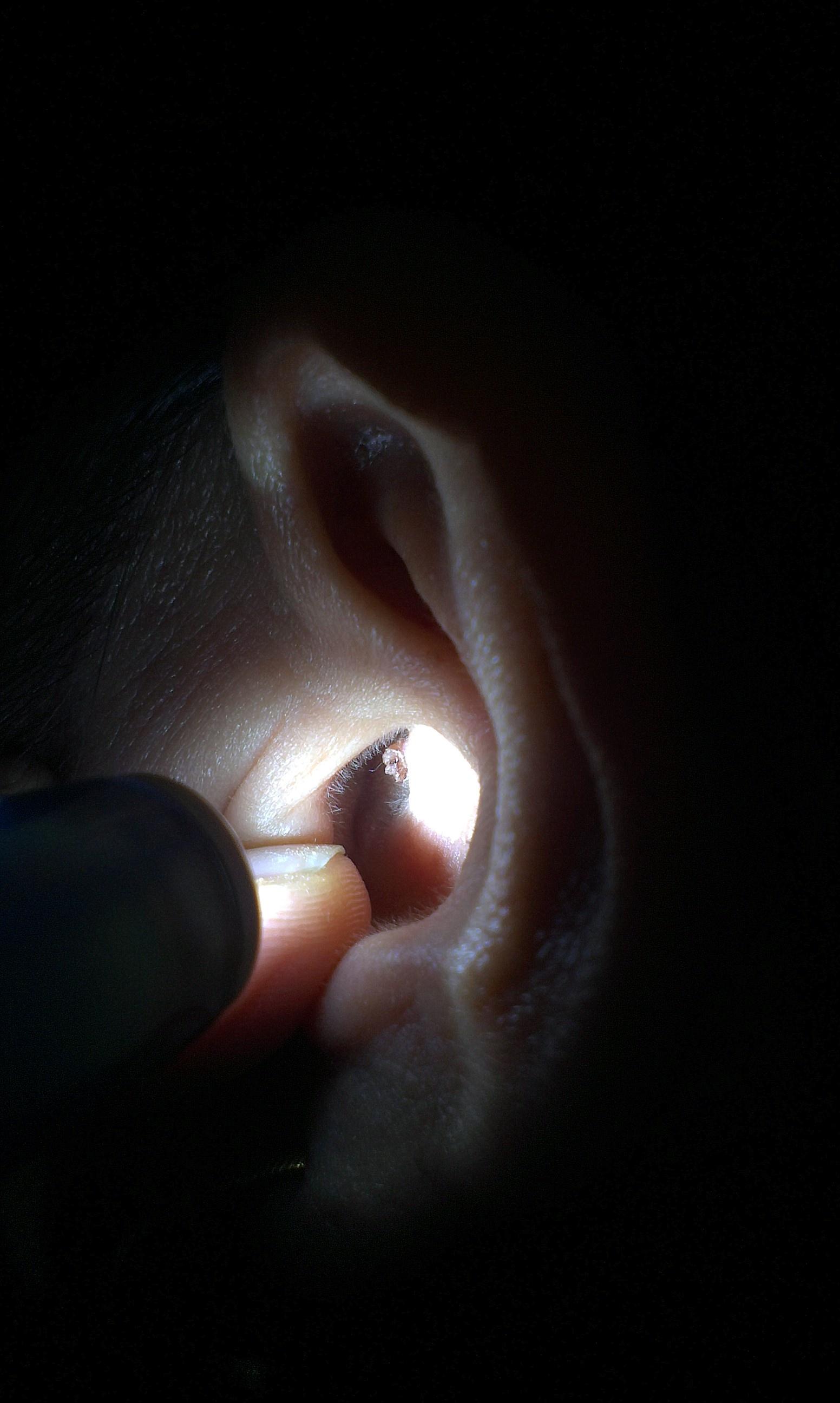 外耳道乳头状瘤的样子图片