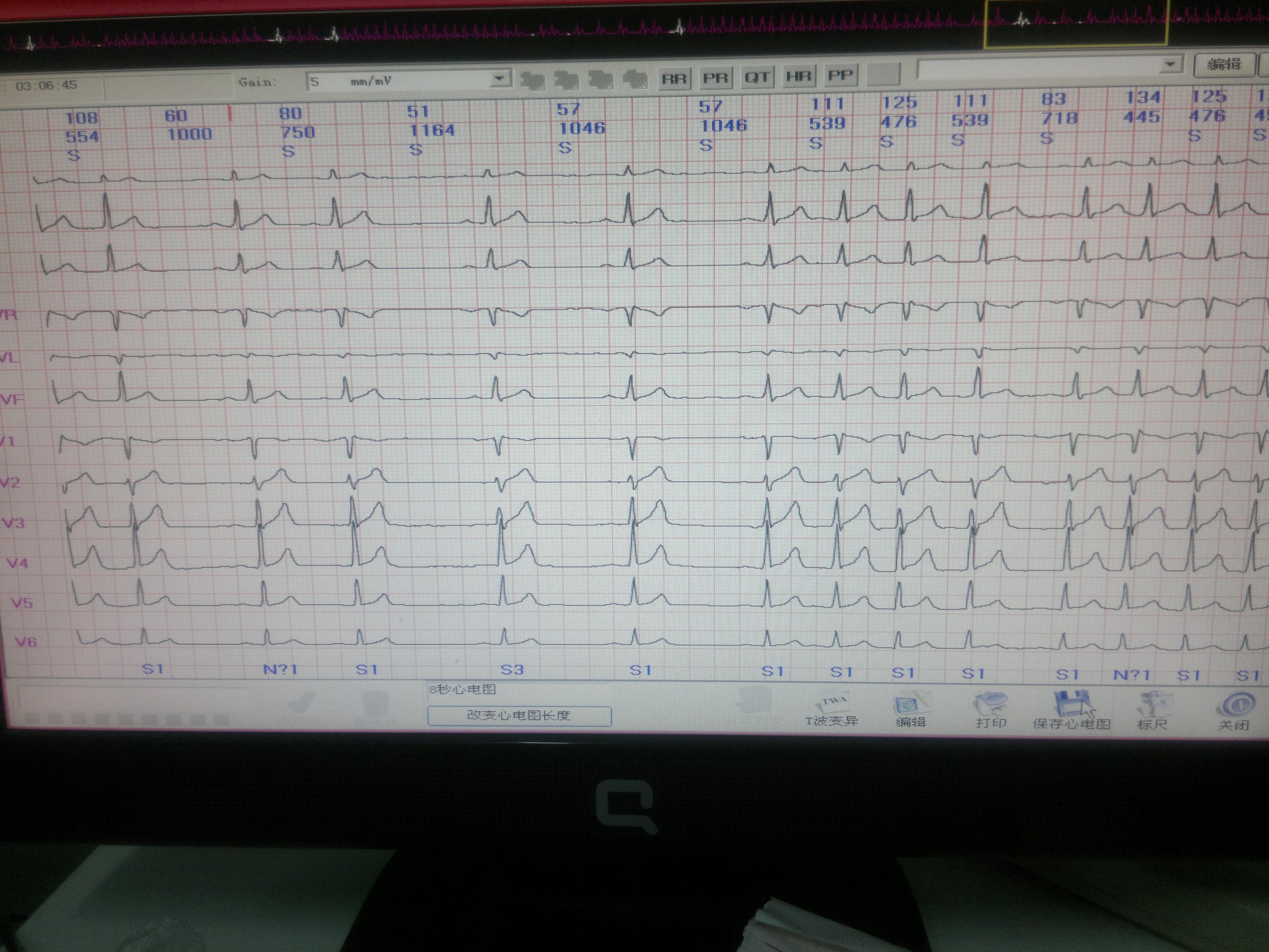 房性心动过速 心电图脑电图专业讨论版 爱爱医医学论坛