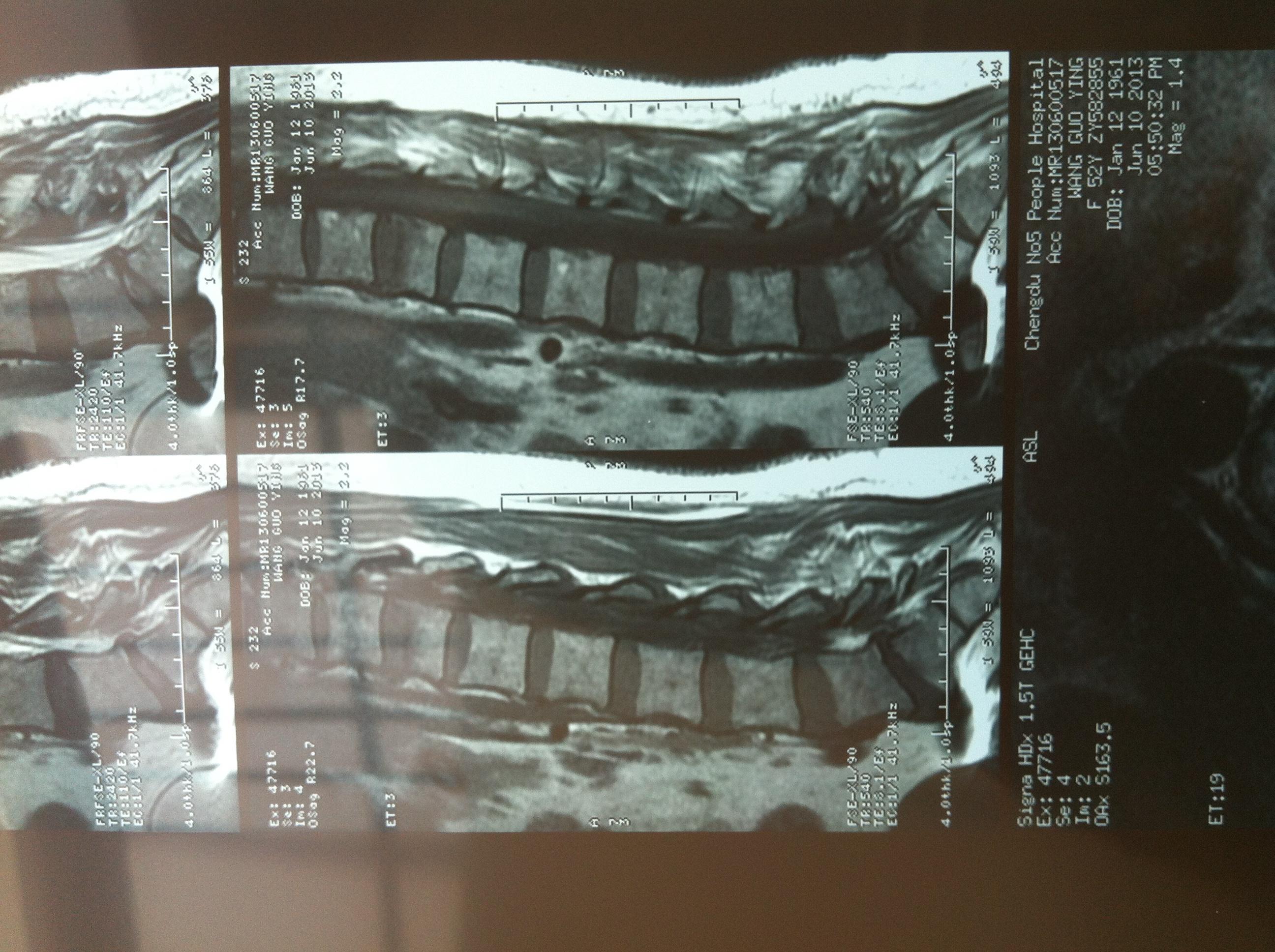胸12椎体爆裂性骨折图片