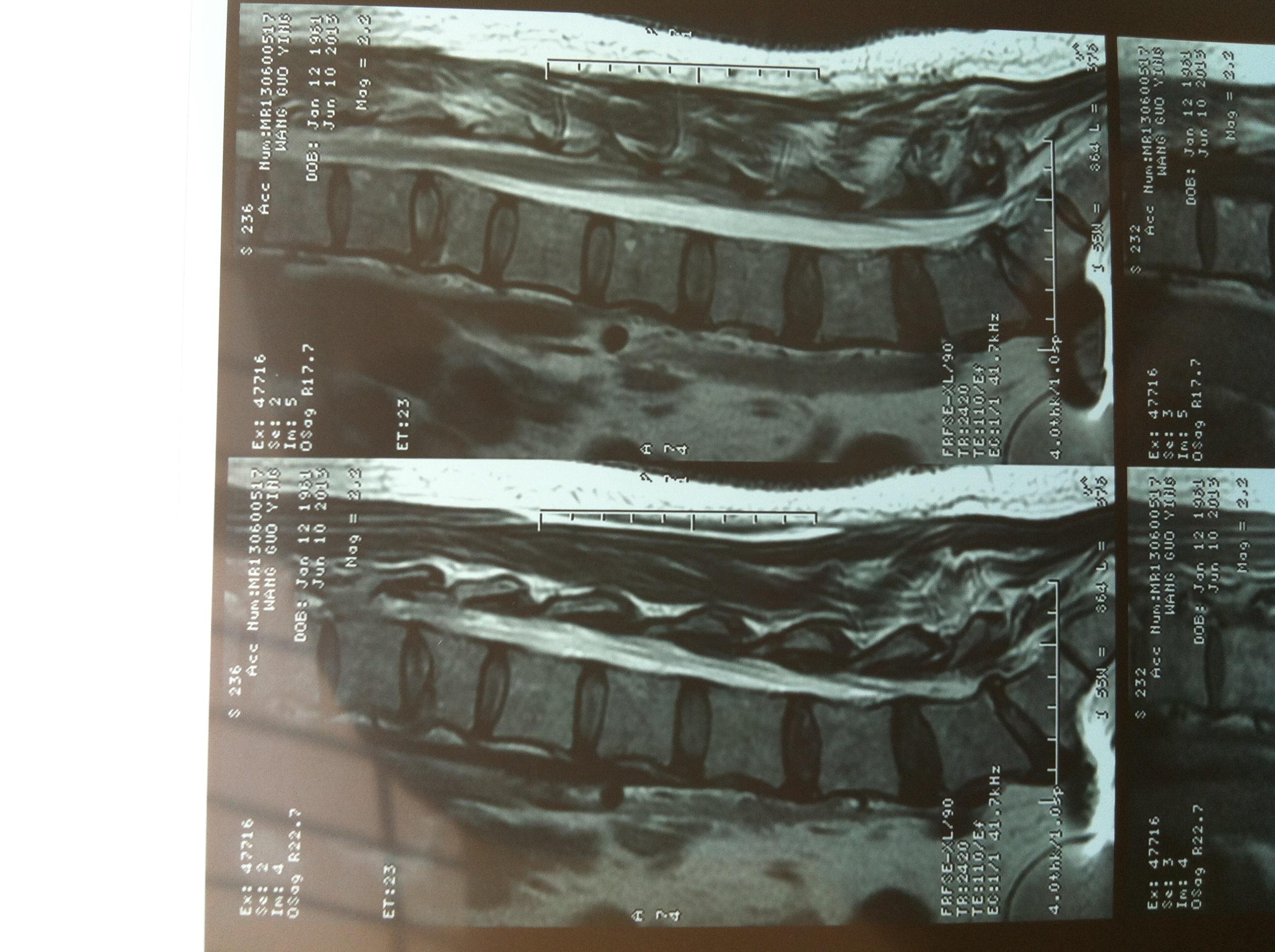 胸12椎体爆裂性骨折图片