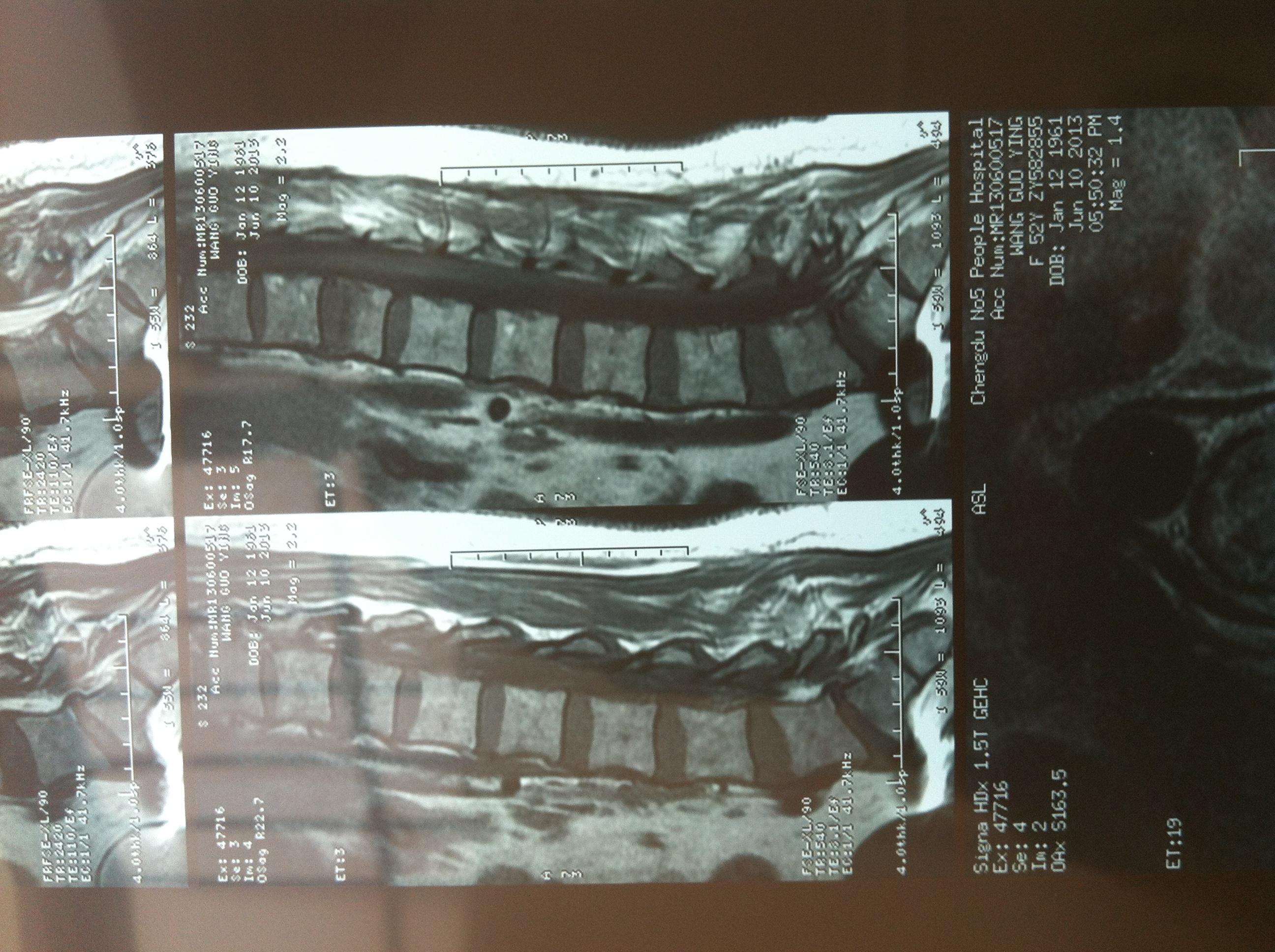 胸十二压缩性骨折图片