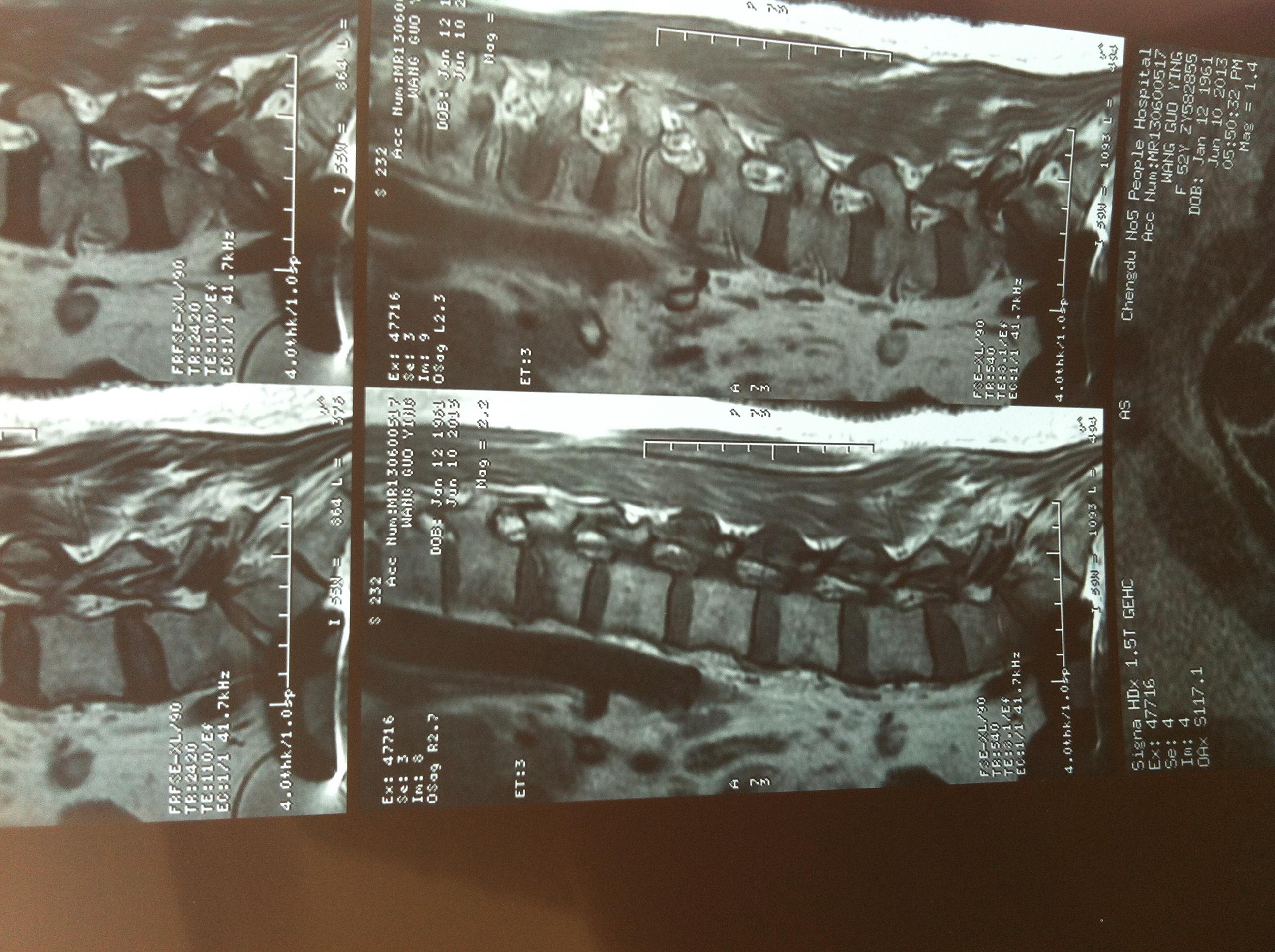 胸12椎体爆裂性骨折图片