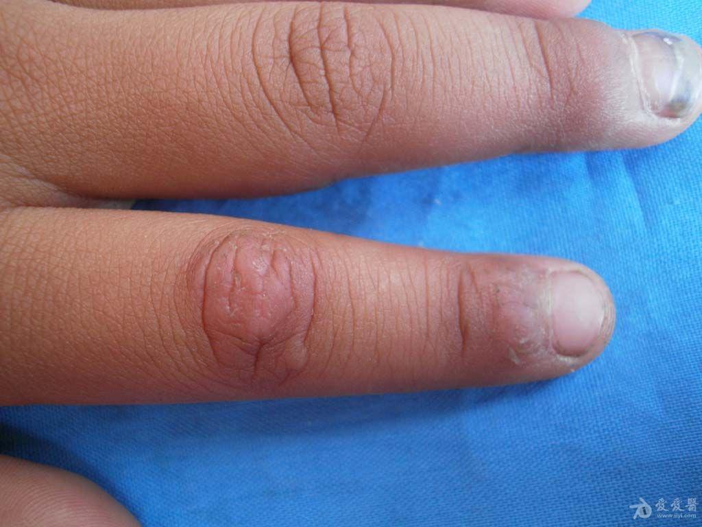 指节垫是什么症状图片图片
