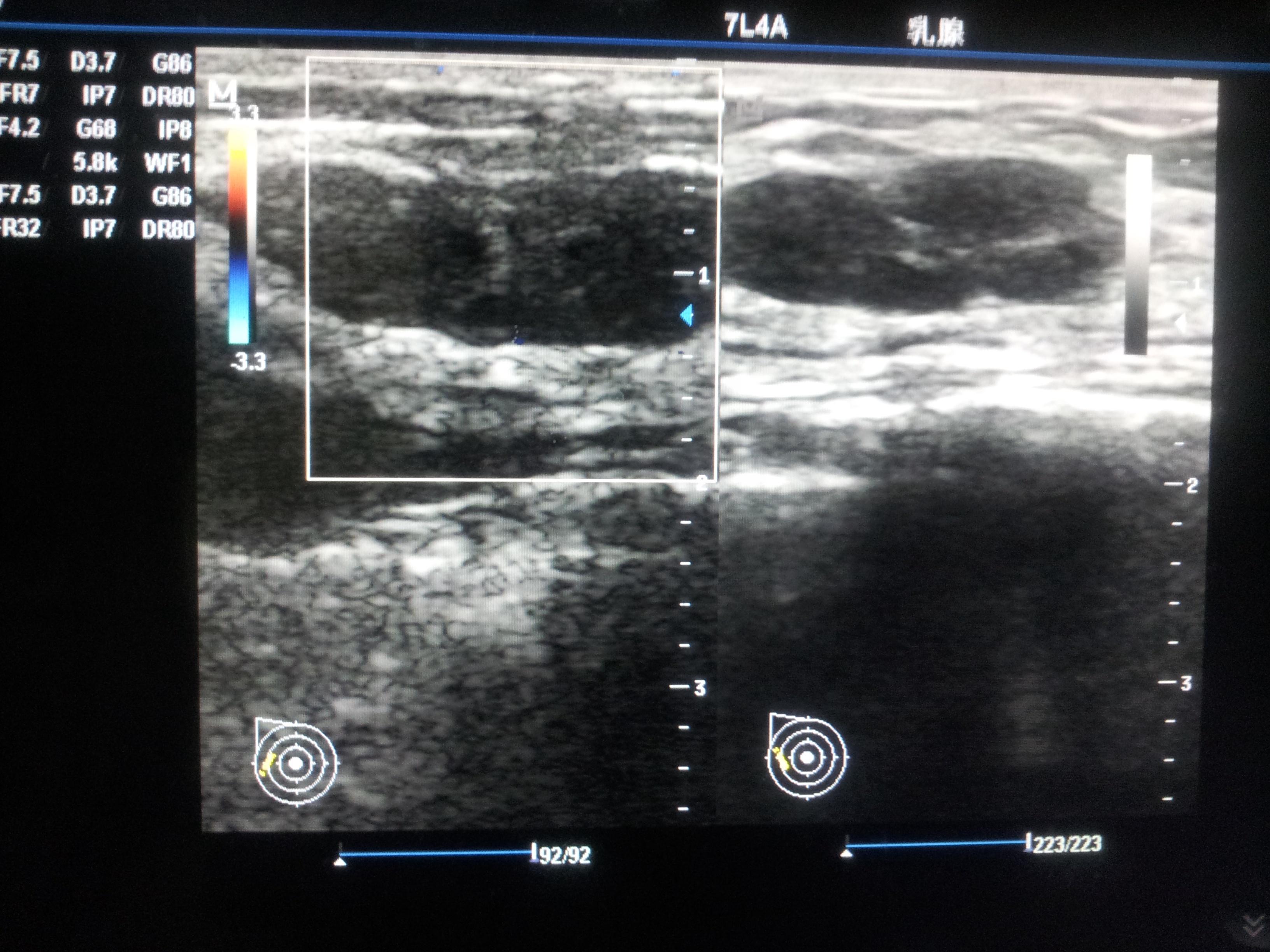 乳腺纤维瘤,有没有乳腺增生? - 超声医学讨论版 - 爱爱医医学论坛