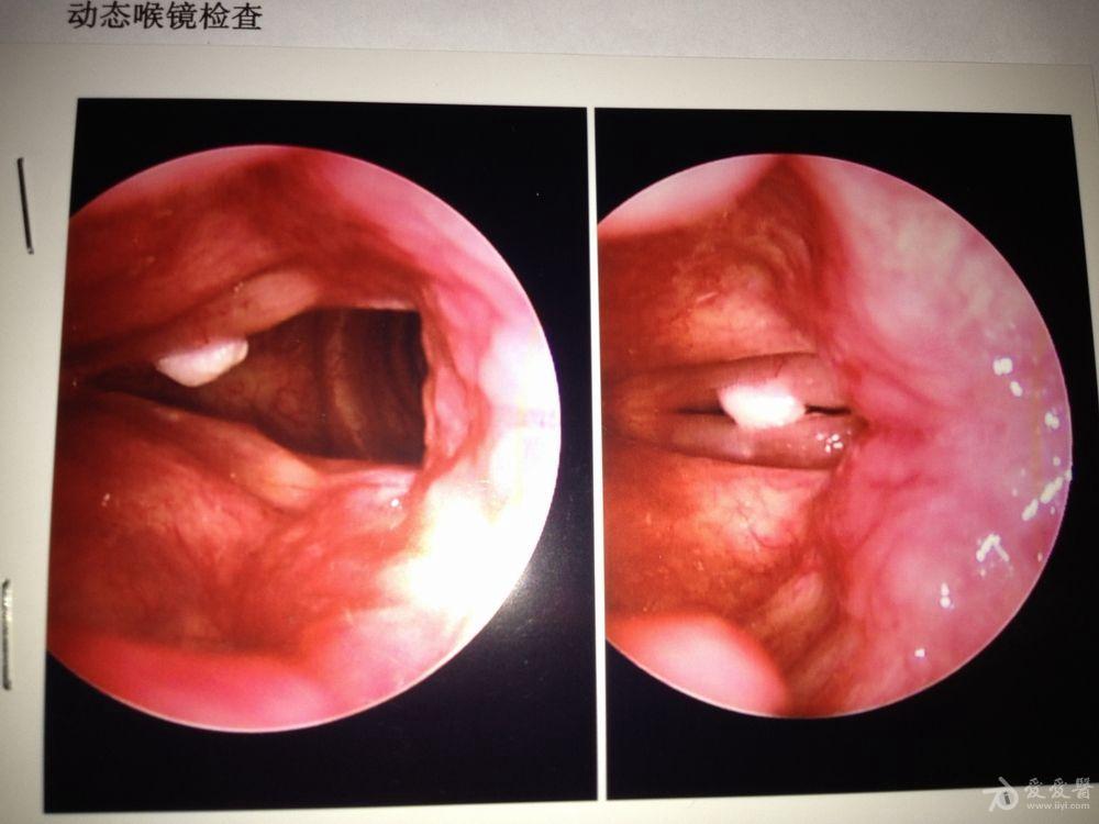 正常喉镜下的喉咙照片图片