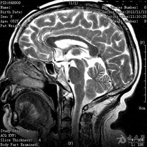 延髓核磁图片