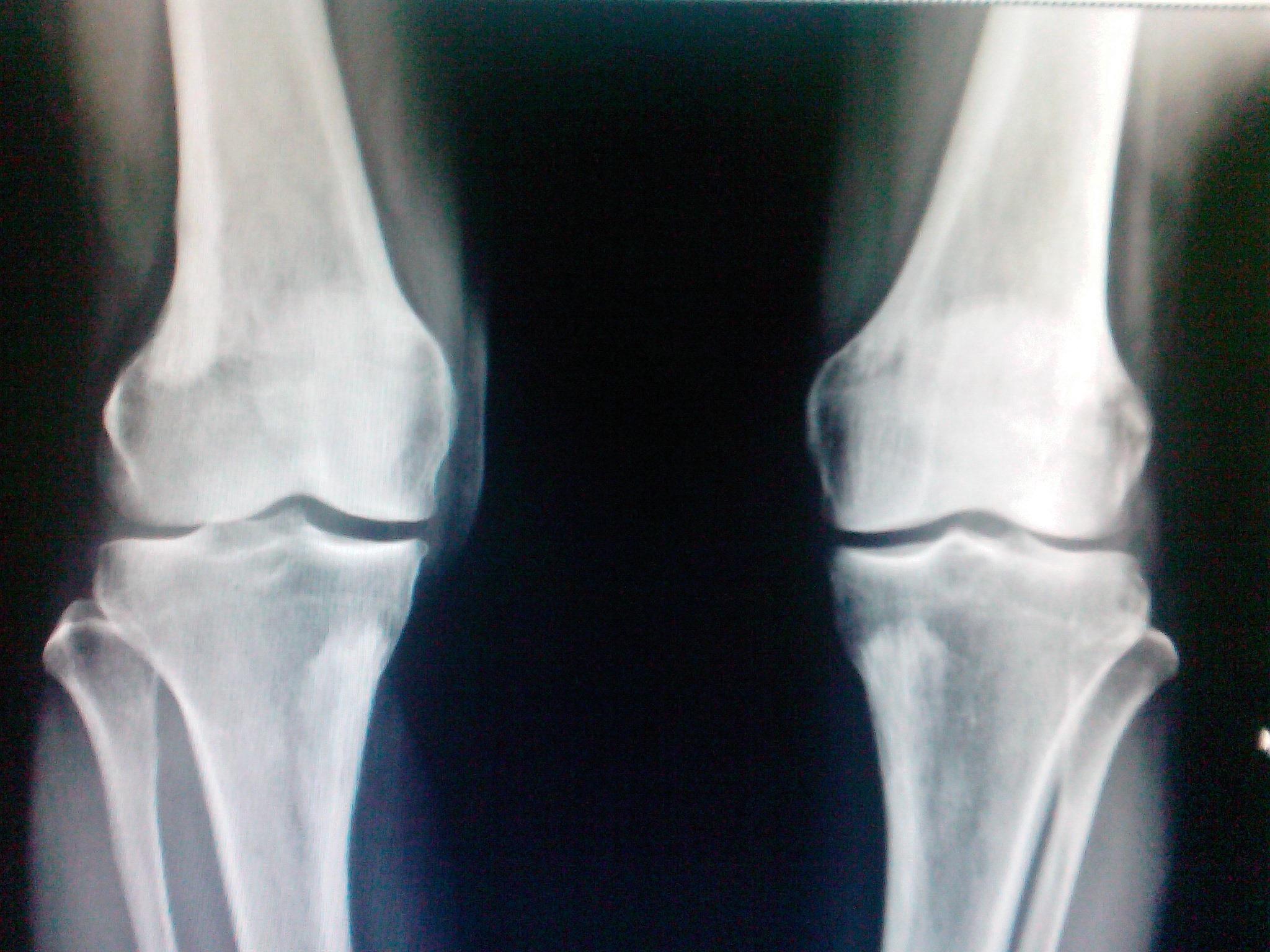 膝盖正常x光片子图片图片