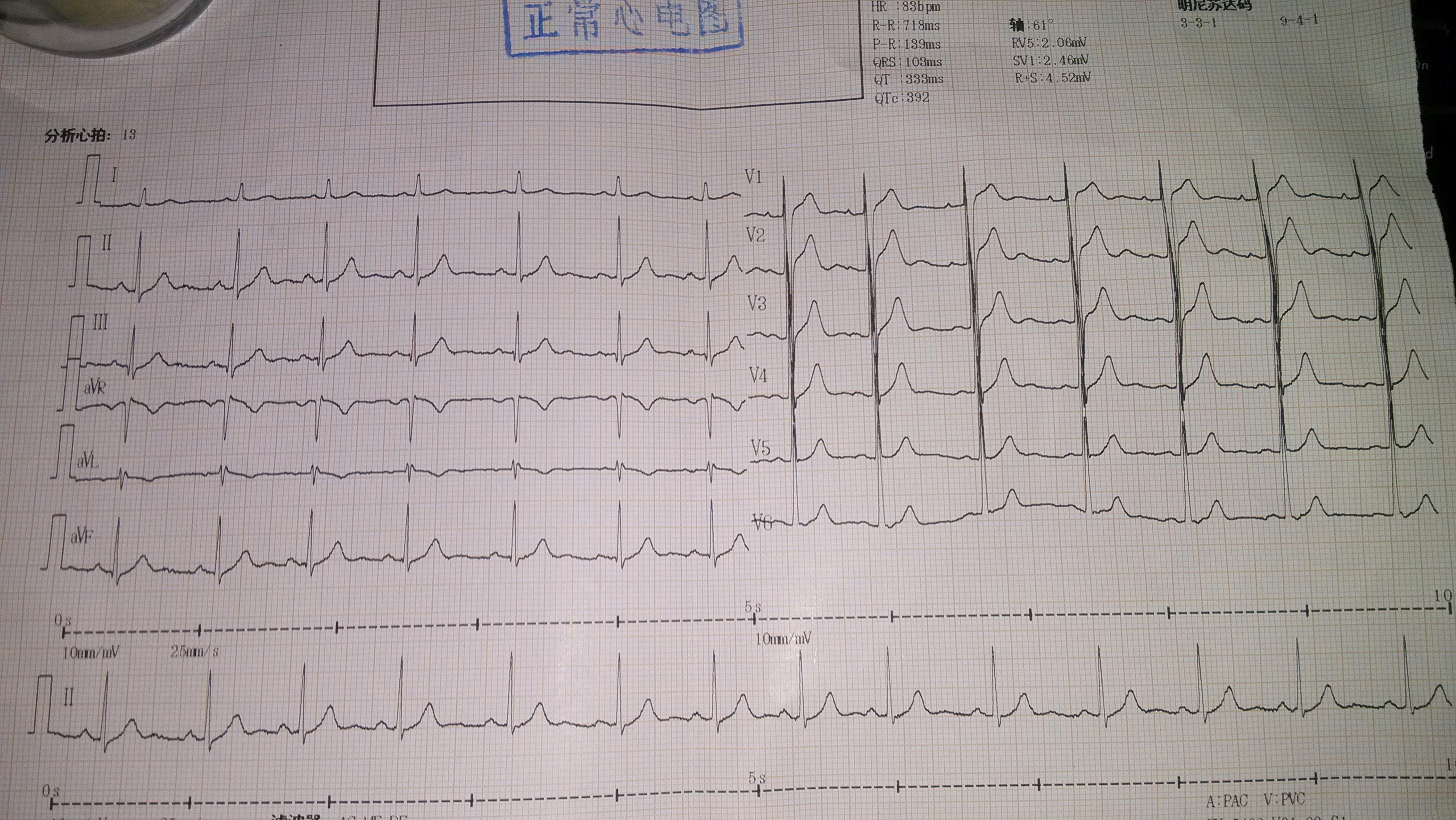 左心室肥大心电图图片