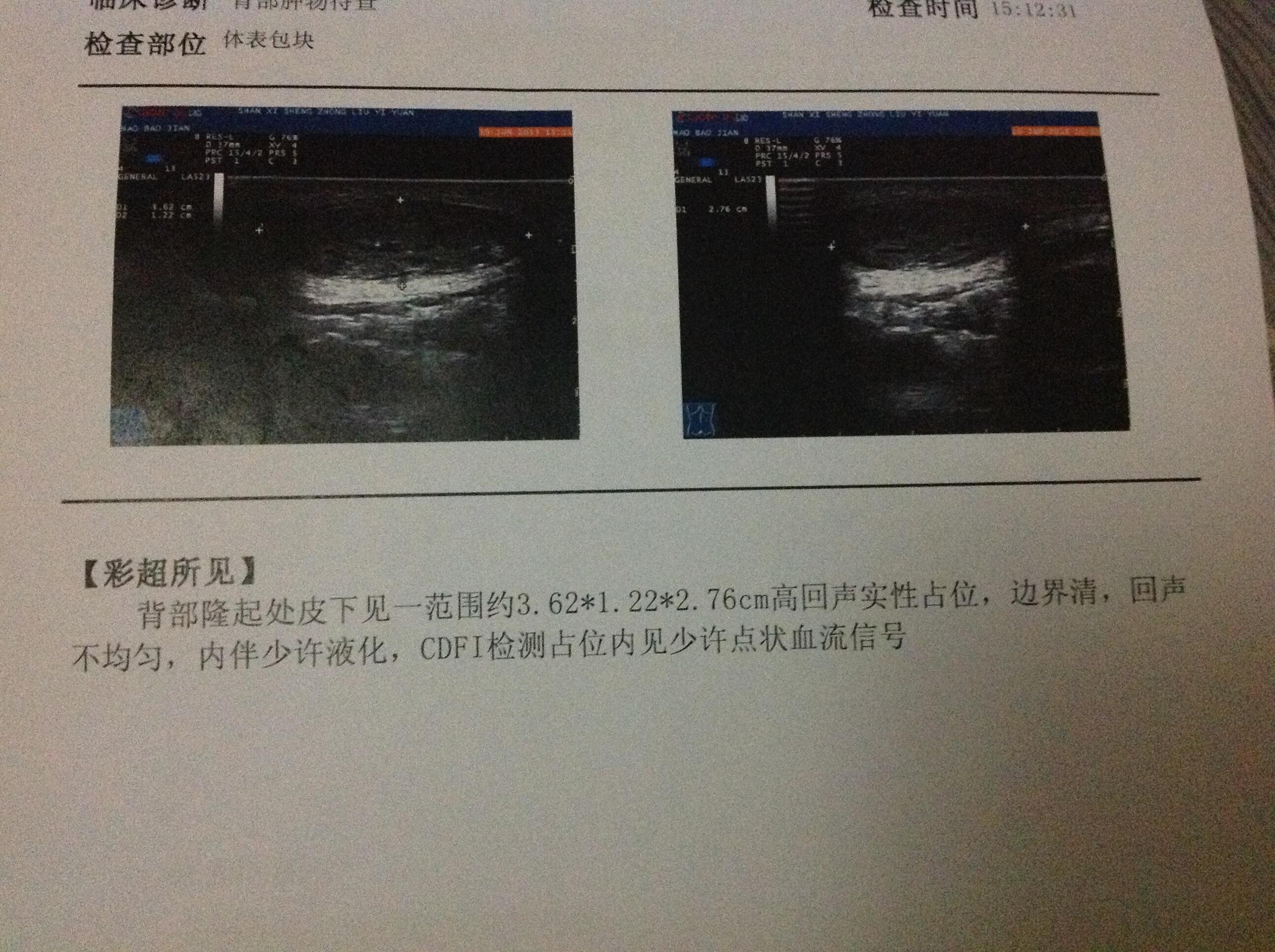背部肿块帮我看看做的彩超