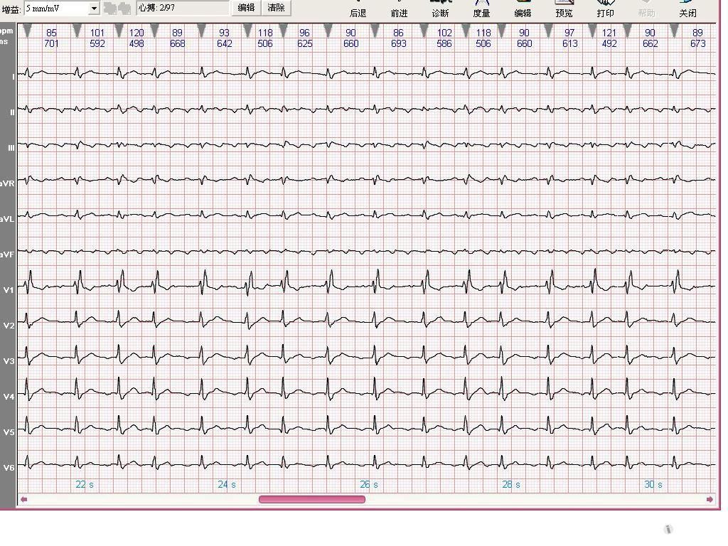 房扑3比1心电图图片