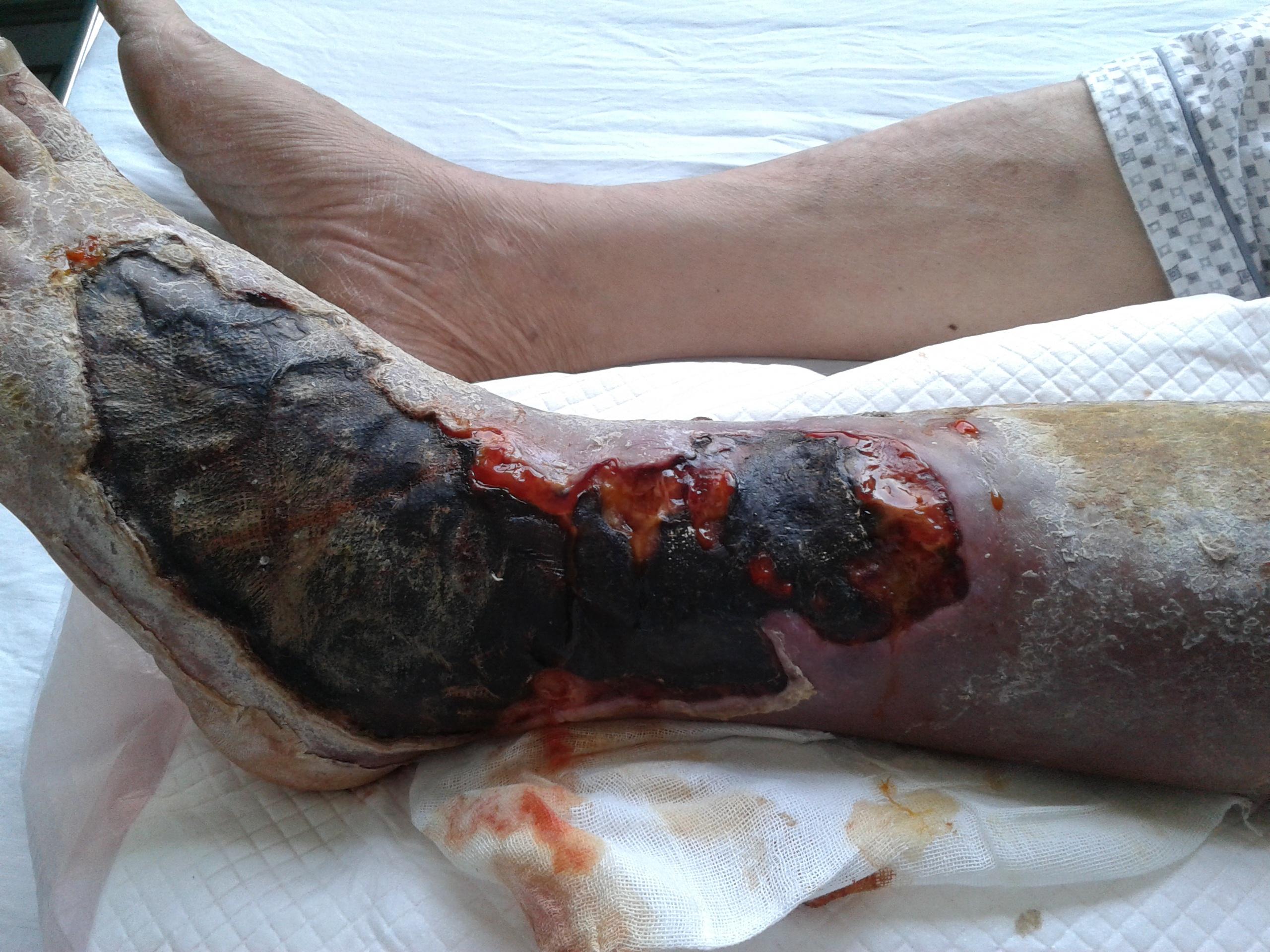 不明原因的大面积坏死怎么治疗