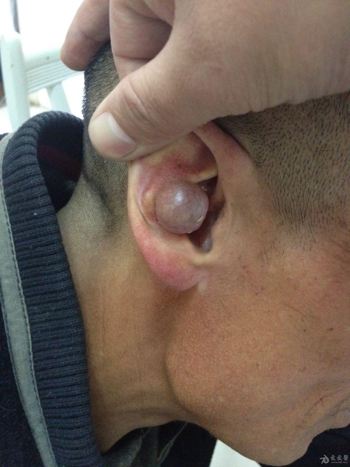 耳廓软骨瘤图片