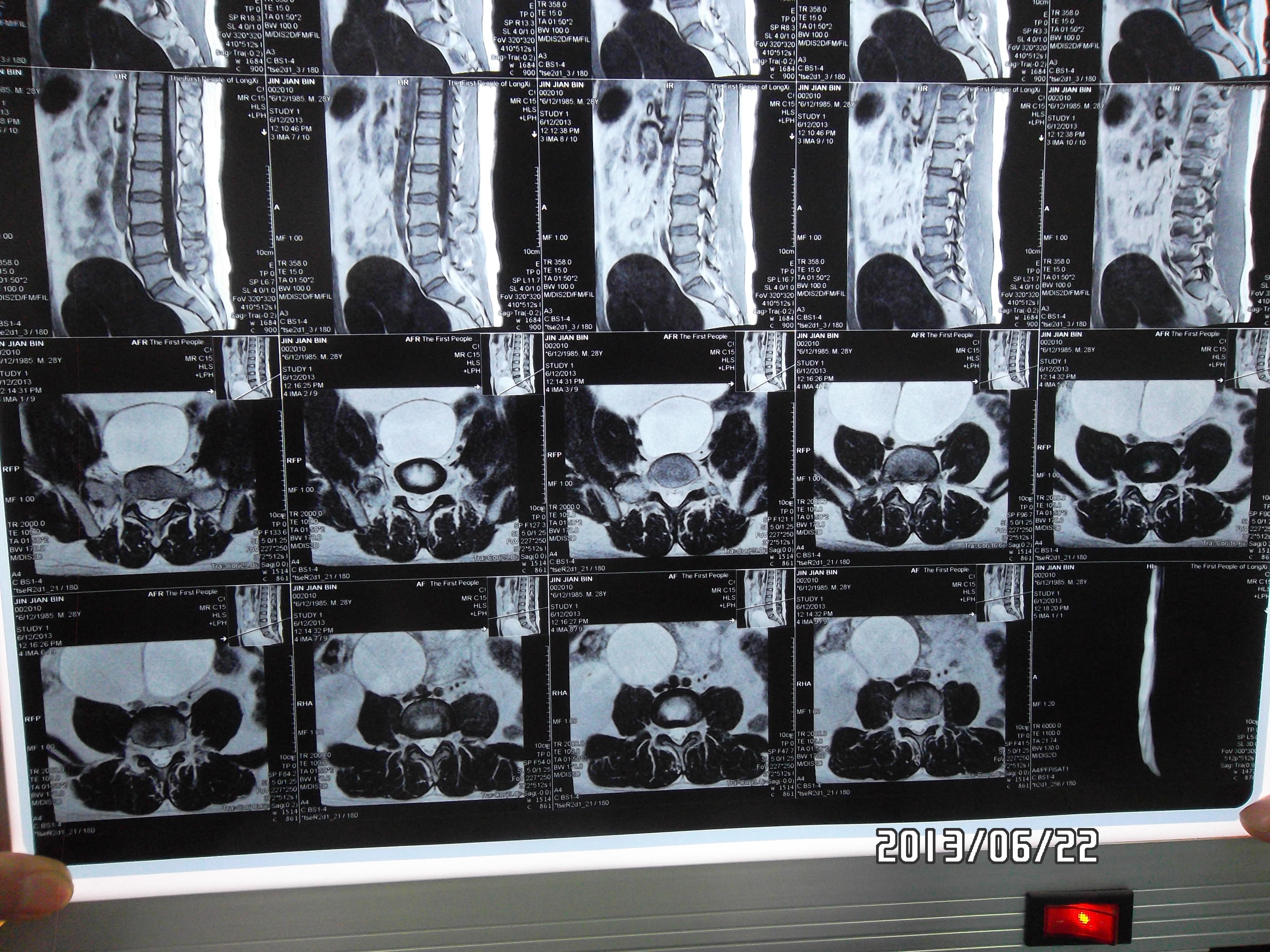 一右腹部巨大囊肿患者求普外高手会诊