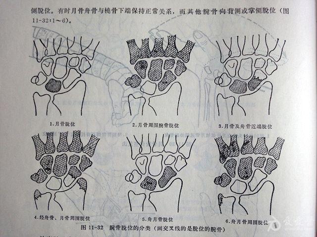 舟骨脱位图片