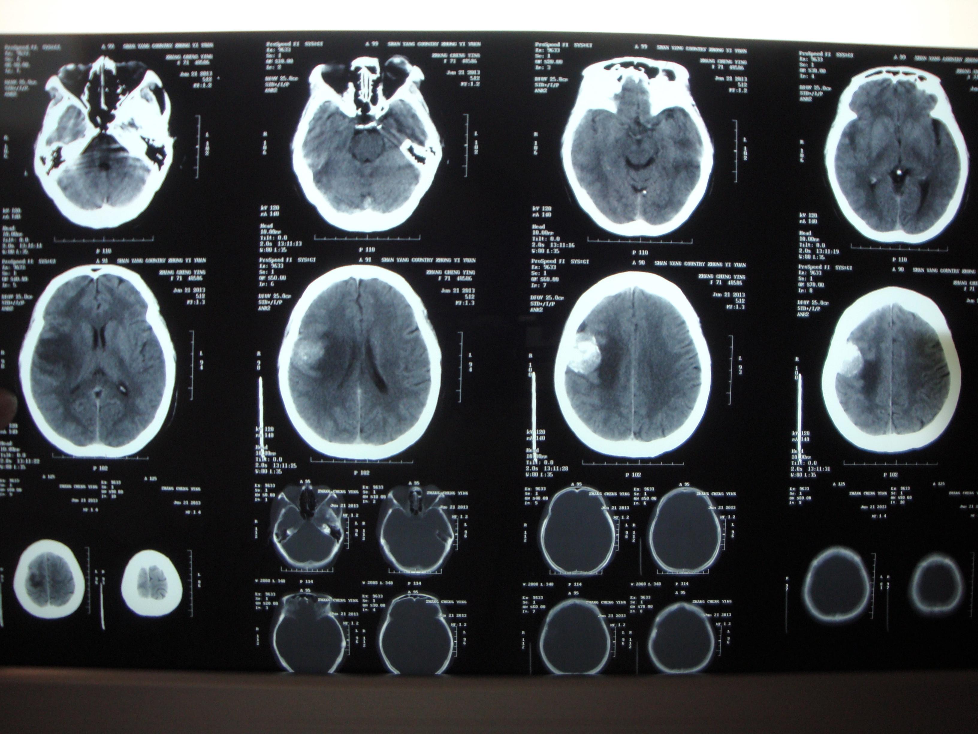 脑膜瘤照片图片