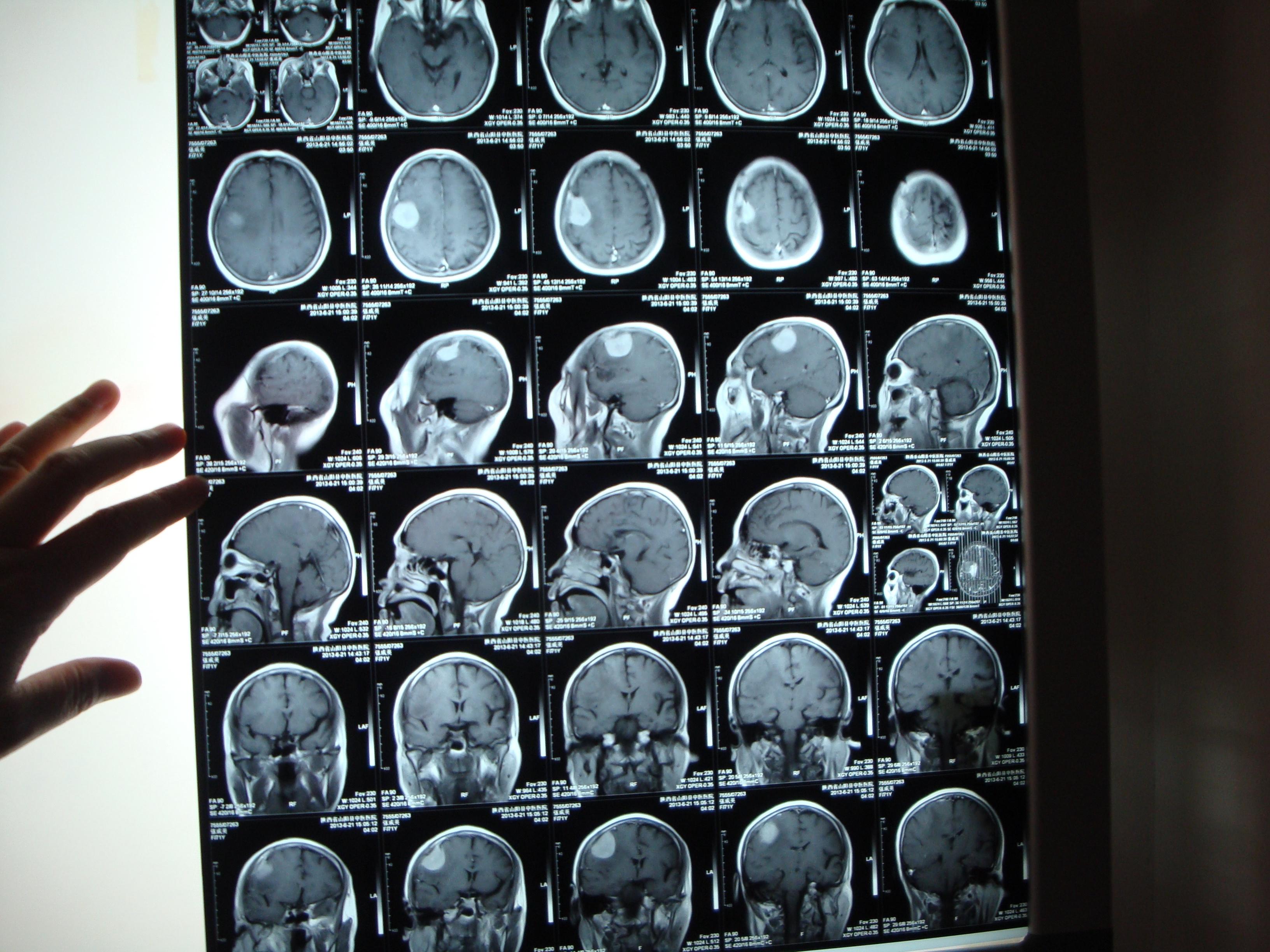 脑瘤ct图图片