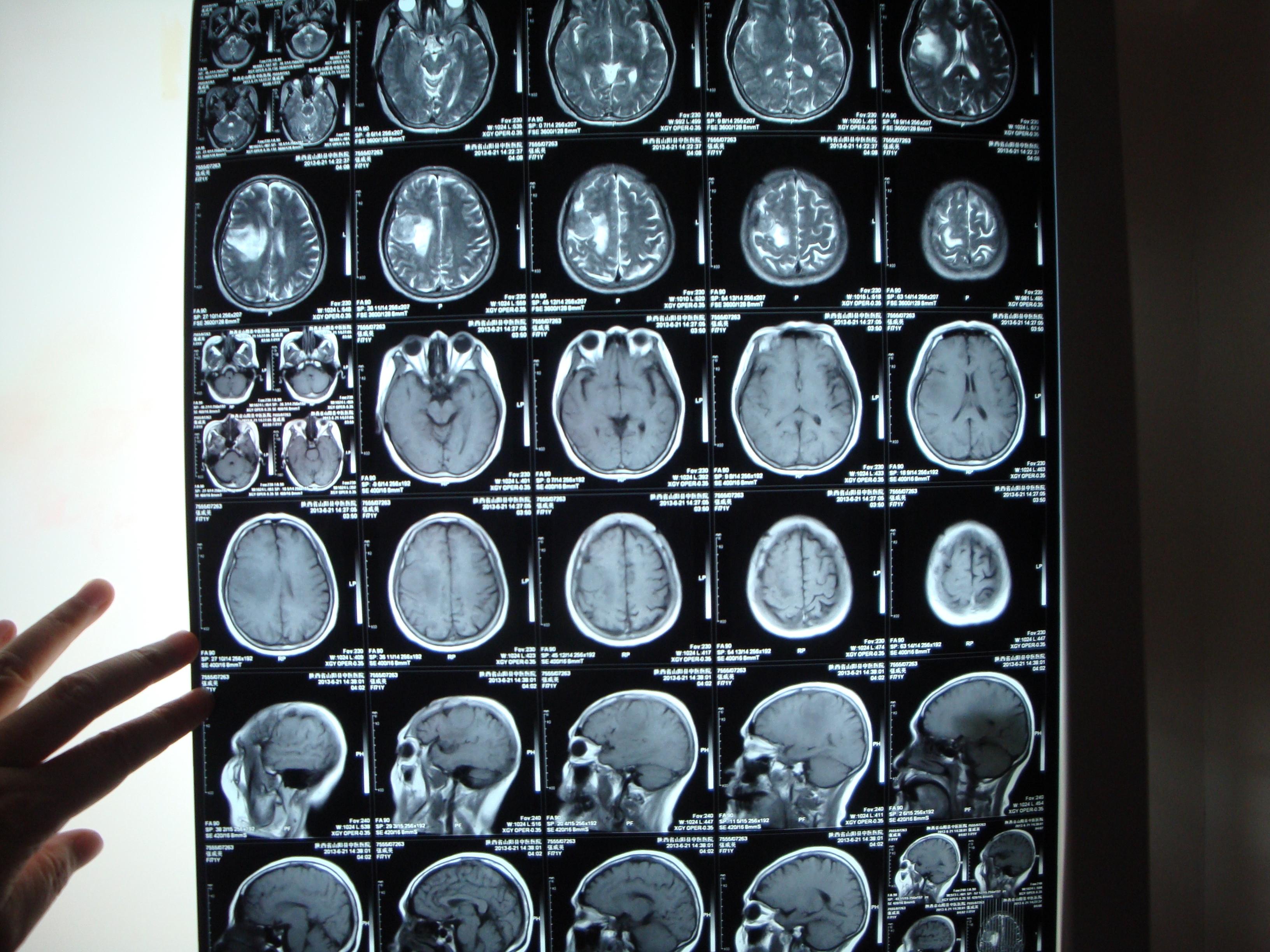 脑膜瘤的ct表现图片