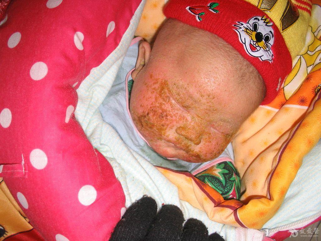 婴儿脂溢性皮炎症状图片
