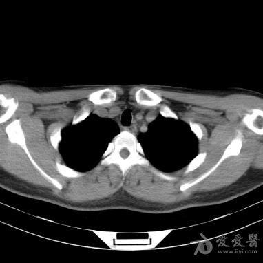 永存左上腔静脉