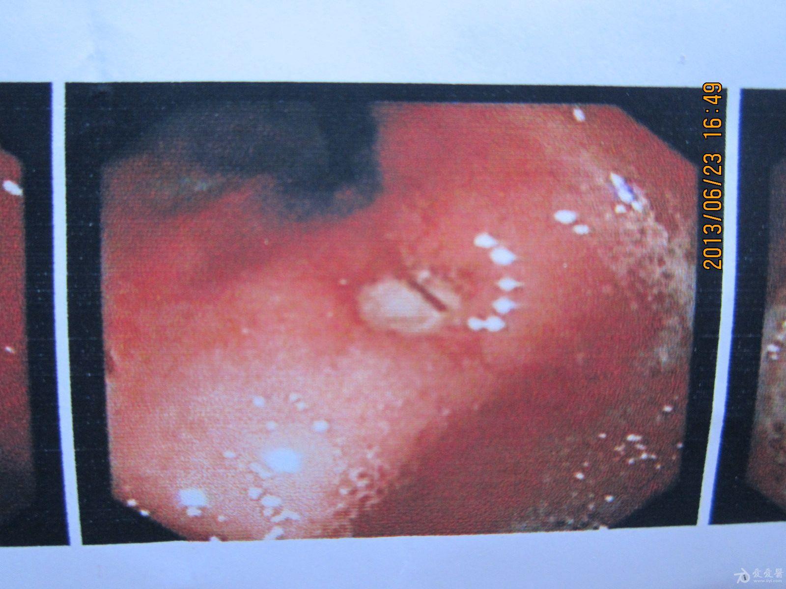 胃部火山口状溃疡图片