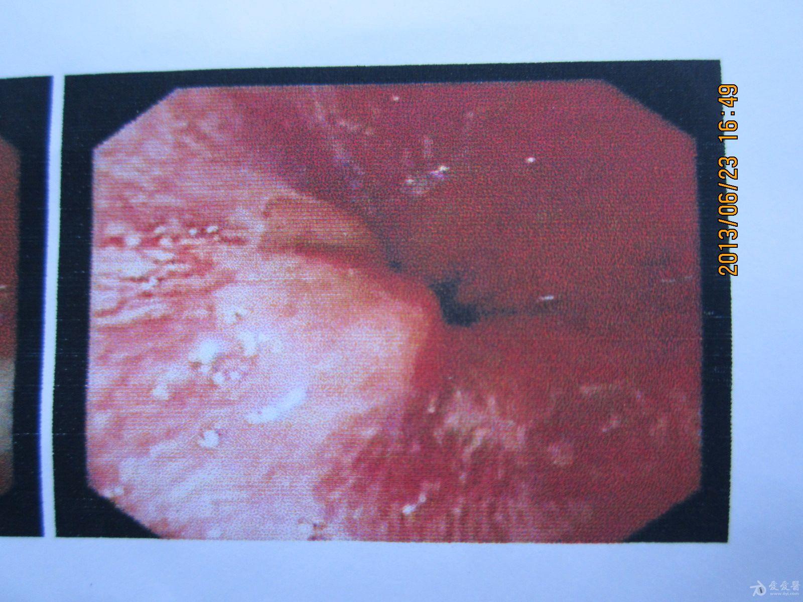 胃溃疡的图片真实照片图片