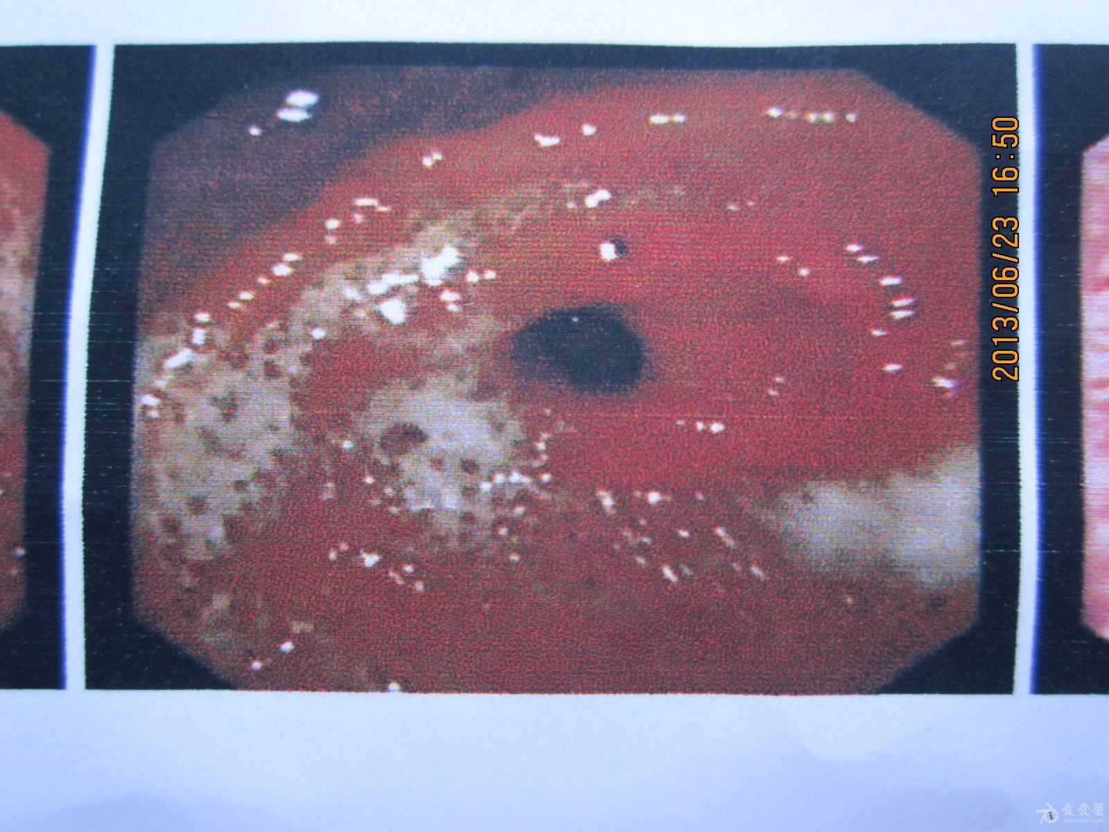 胃窦溃疡图片高清大图图片
