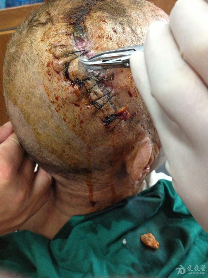 开颅手术愈合后图片图片
