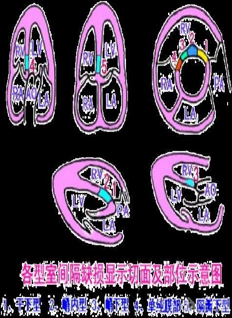 各型室间隔缺损示意图