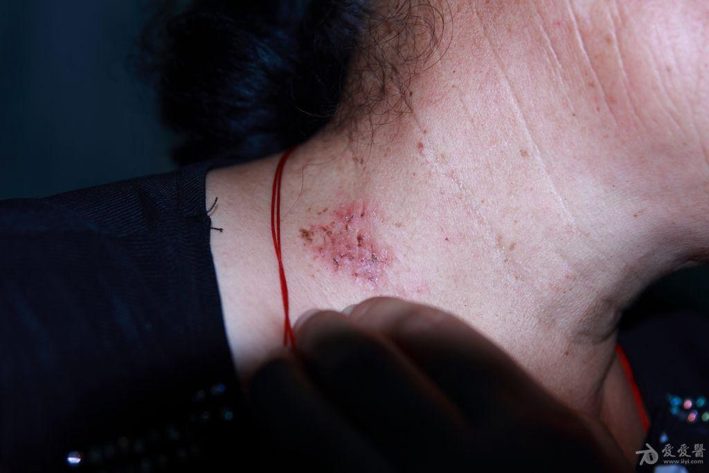 这个病例能否诊断为家族性良性慢性天疱疮