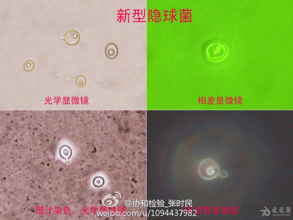 革兰染色新型隐球菌图片