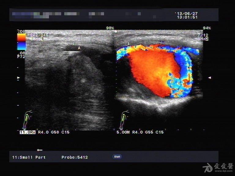 假性动脉瘤超声图片