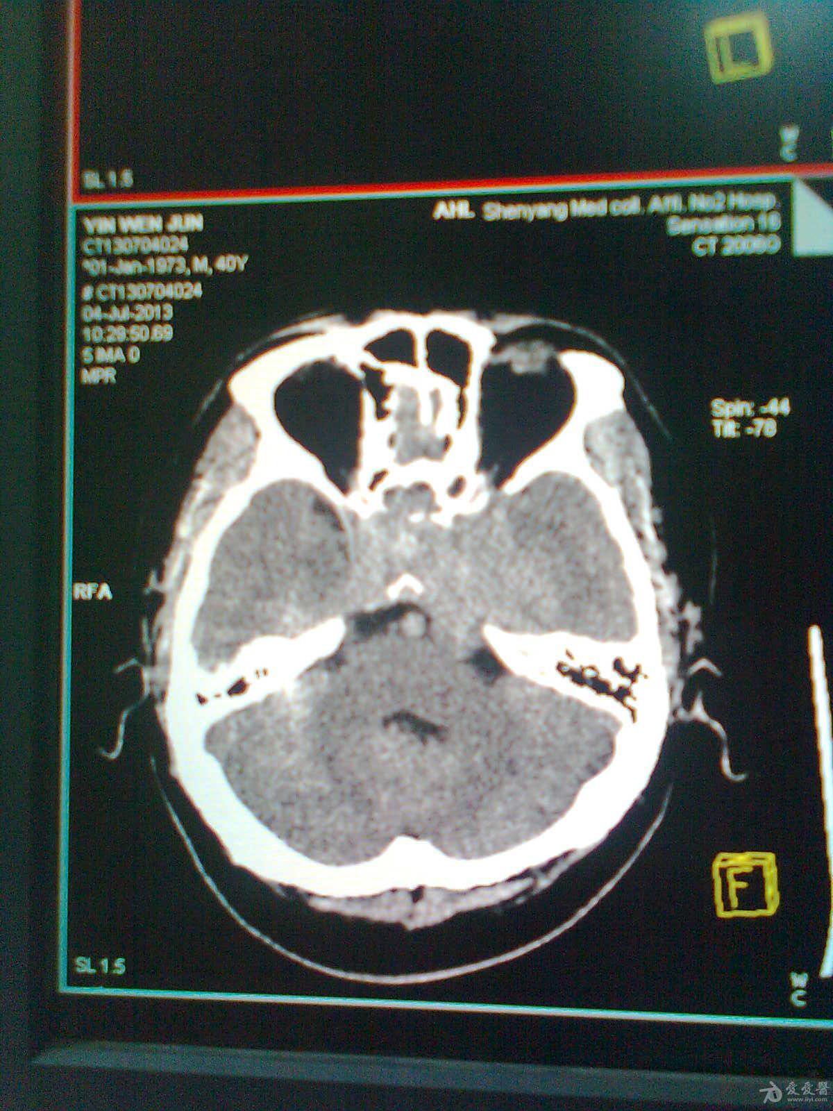 颅底鞍区占位病变