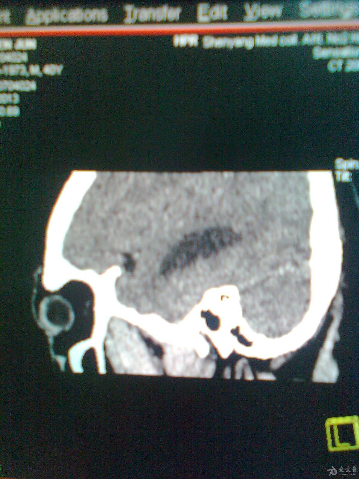 颅底鞍区占位病变