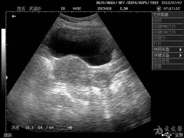 宫颈肥大,可疑前壁肌瘤? - 超声医学讨论版 - 爱爱医医学论坛