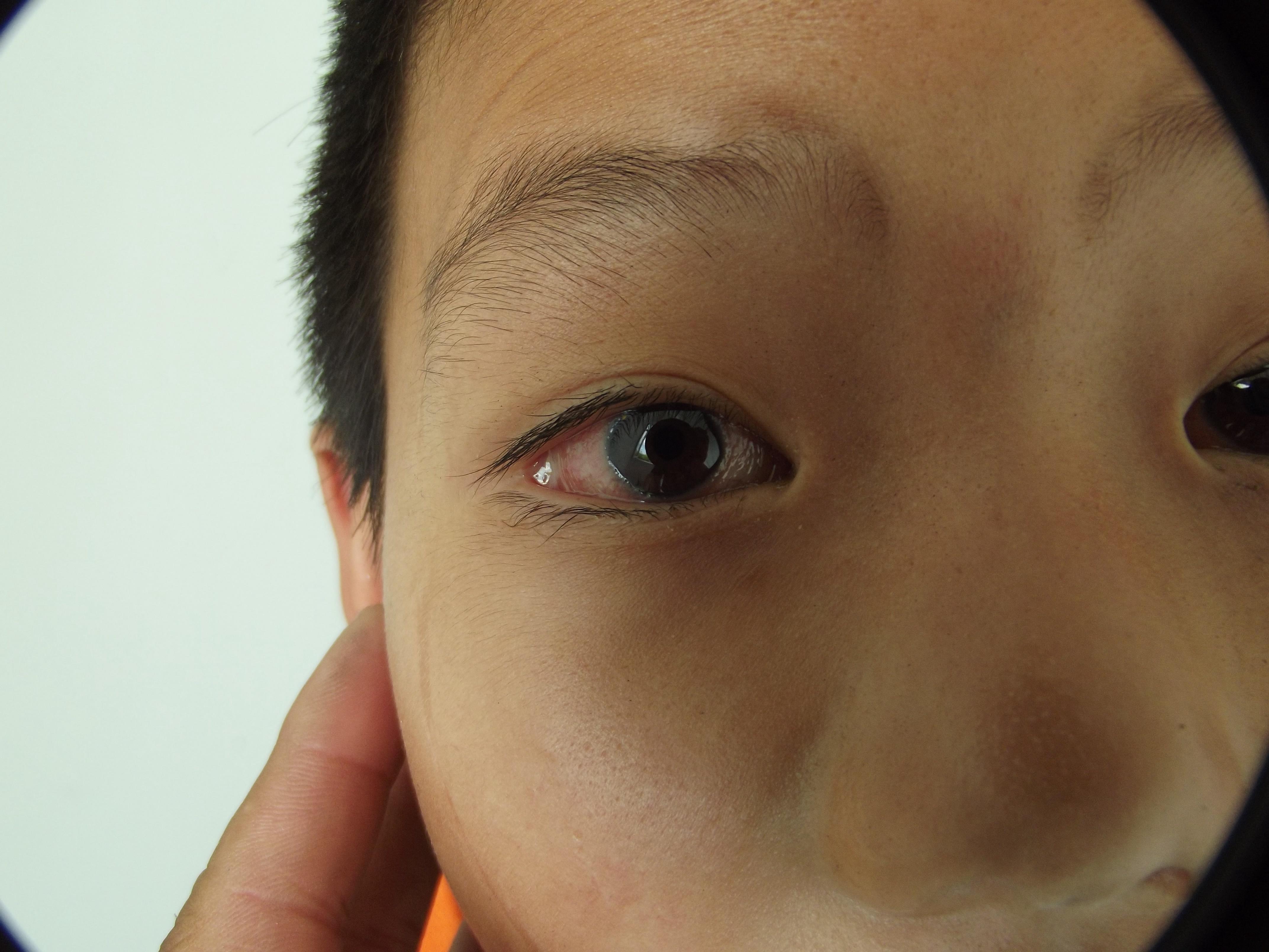 男童双眼结膜充血40天
