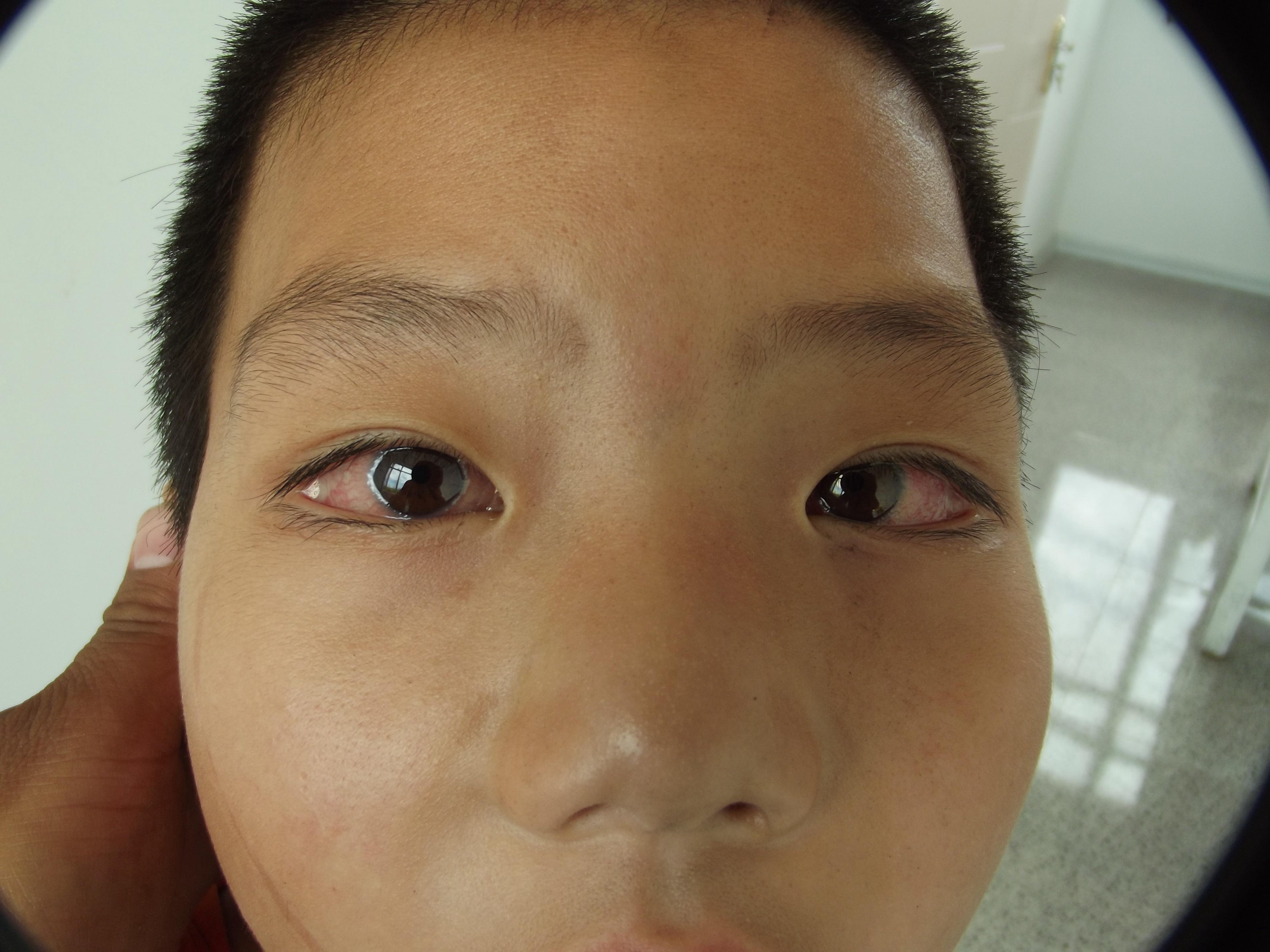 男童双眼结膜充血40天