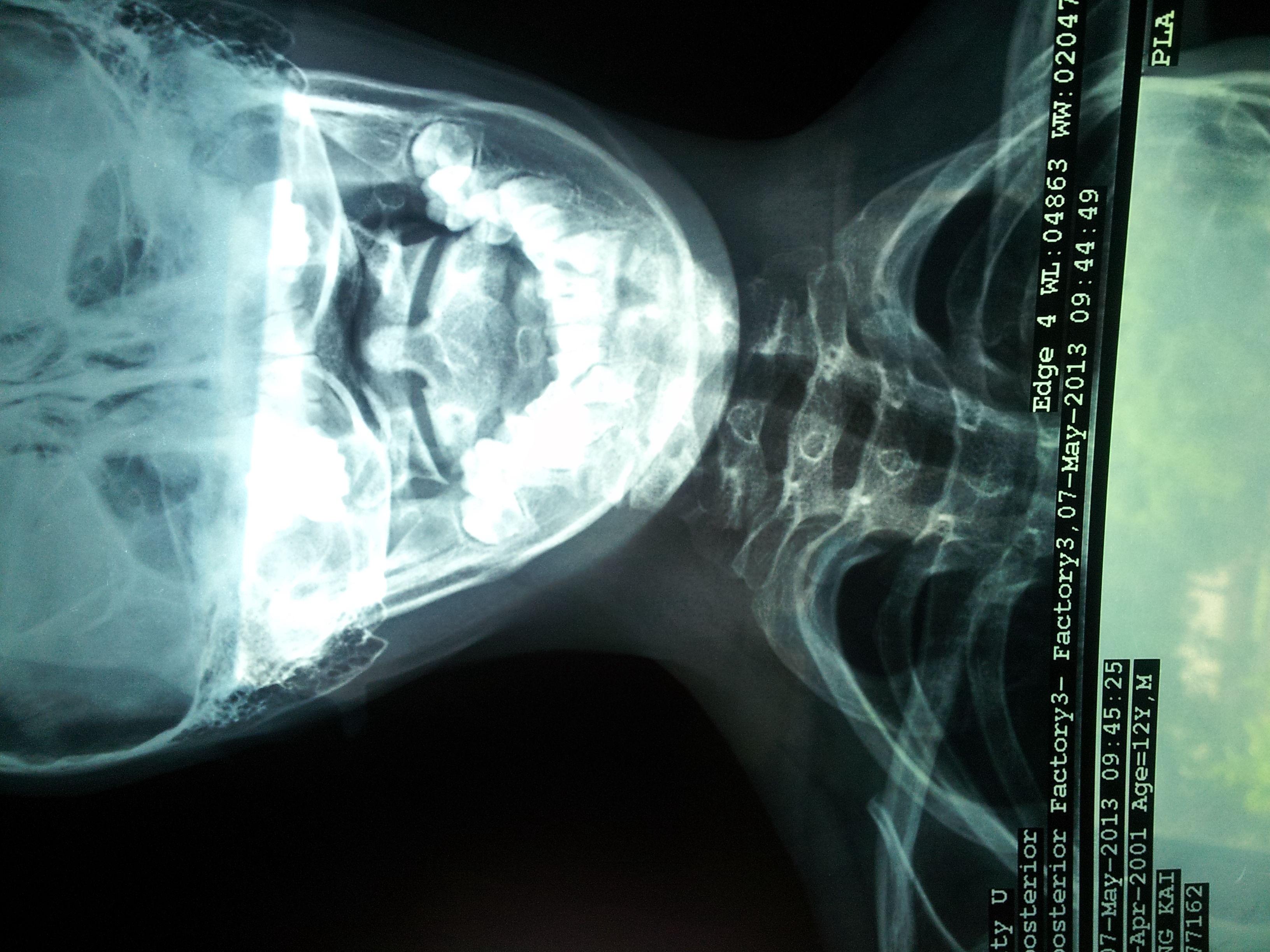 各位同仁我遇到一例棘手的病例请大家会诊