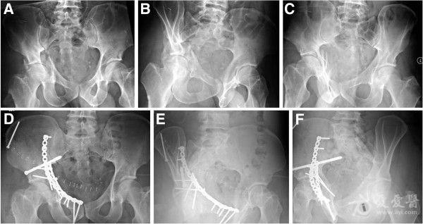 髂骨骨翼骨折图片