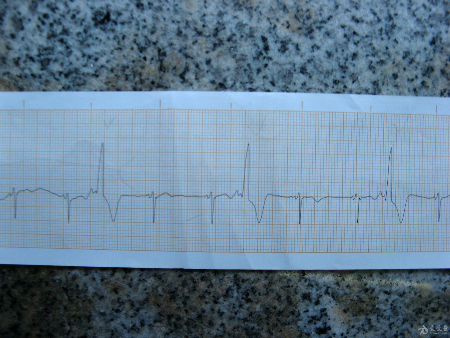 有p波的室早谁见过