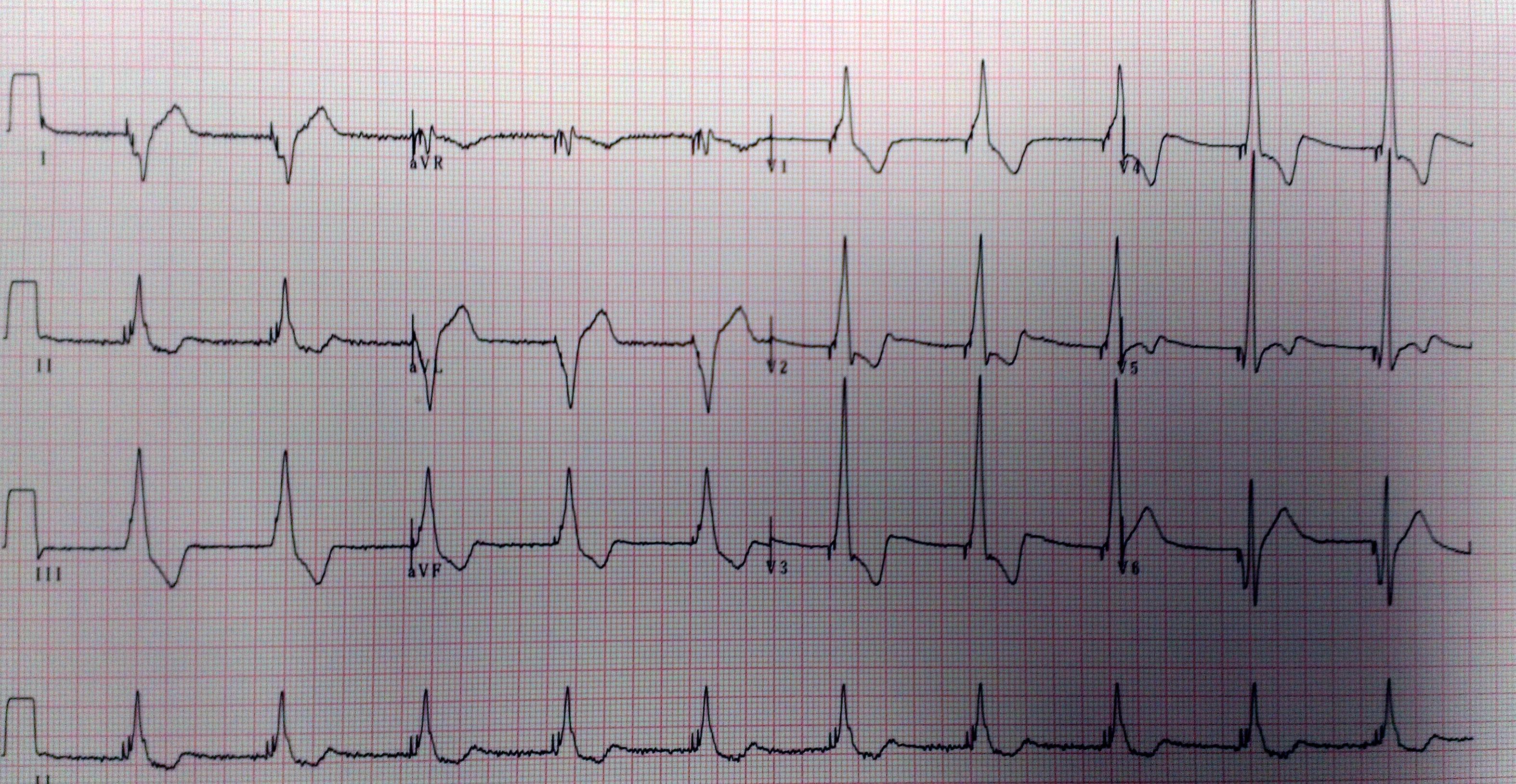 讨论心电图40较典型心电图5